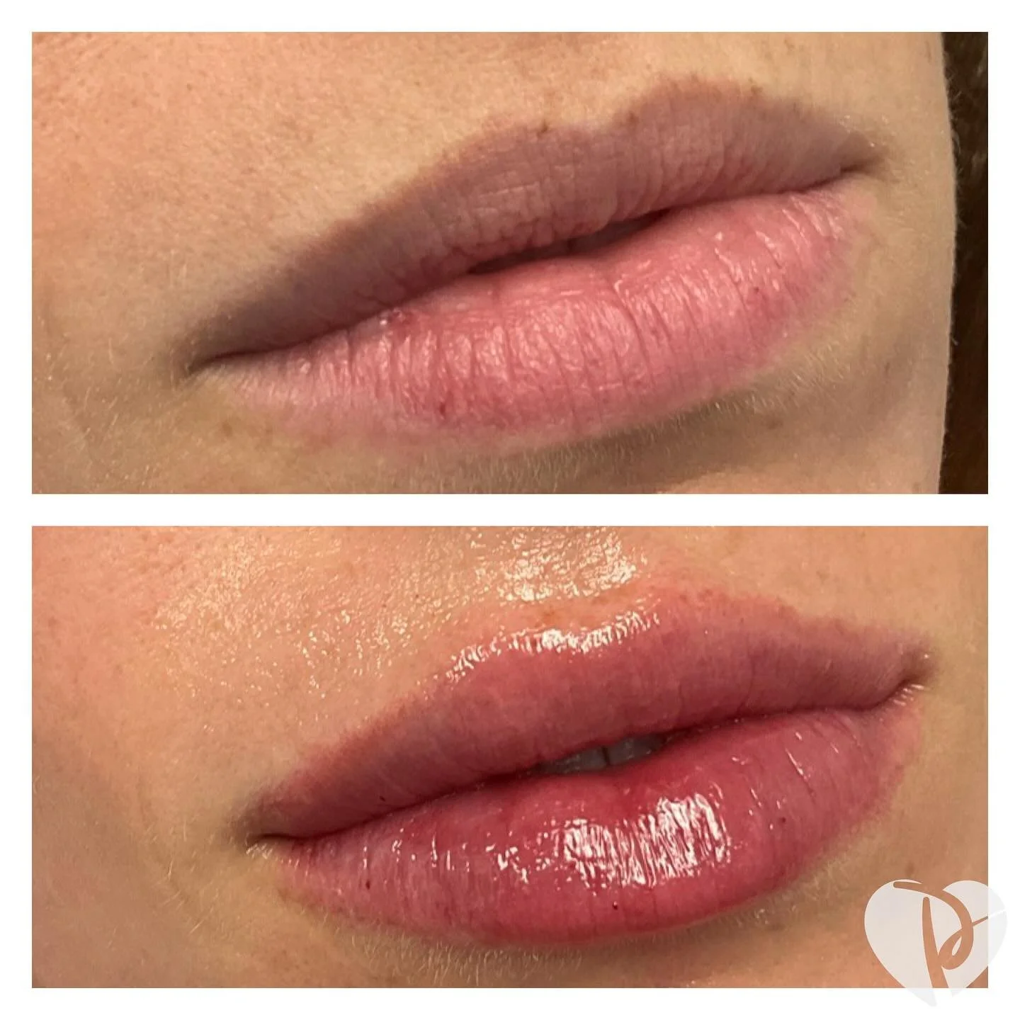 Soft and balanced 💕Just a touch of filler for that perfect &ldquo;your lips but better&rdquo; look 👄
#lajollamedspa #aestheticskinsanctuary #NaturalEnhancement #LipFillerBeforeAfter #sandiegomedspa