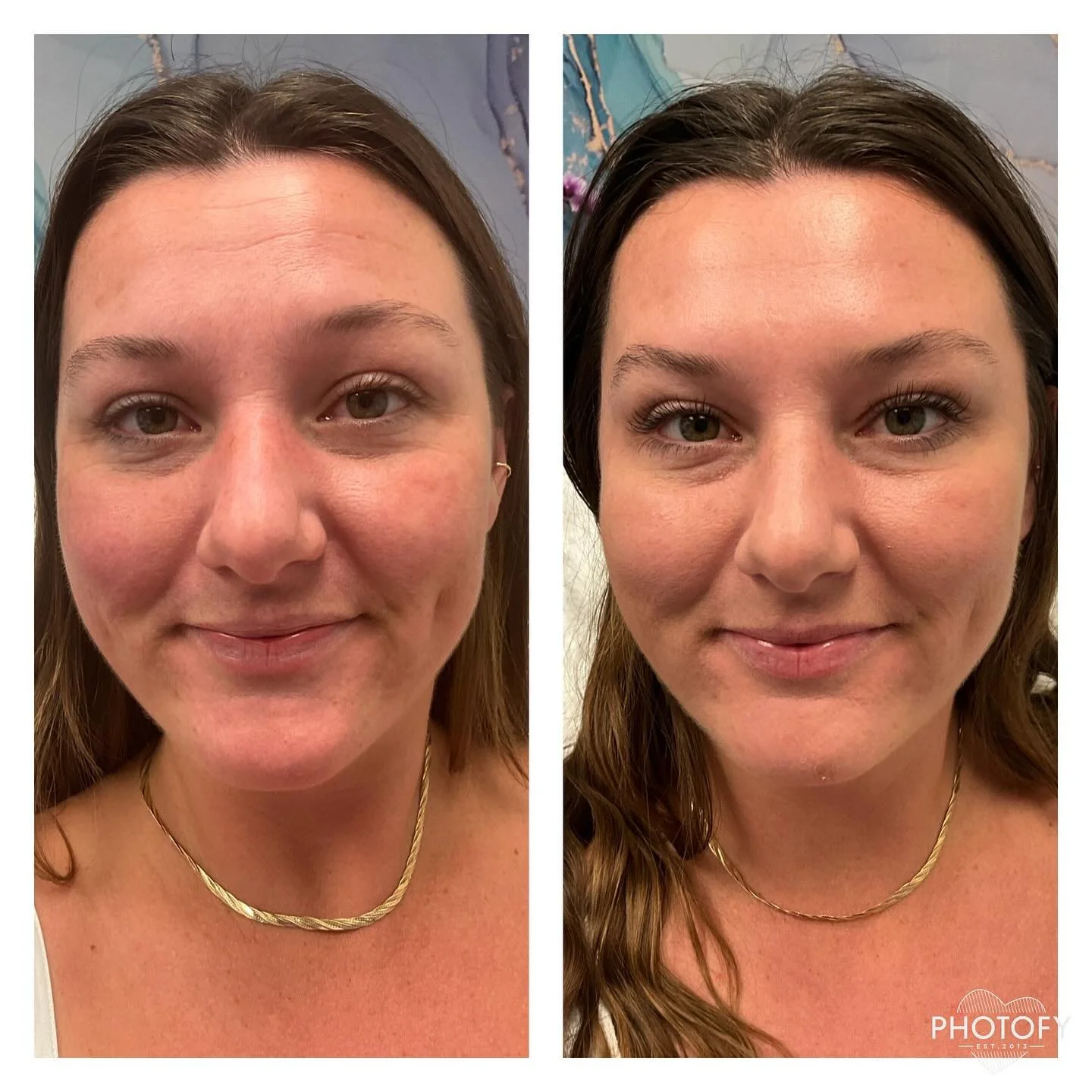 ✨ Subtle change. Dramatic impact.
Notice the smooth forehead lines? With consistent Botox every 3&ndash;6 months, fine lines fade and results last longer&mdash;naturally. 💉

#AestheticSkinSanctuary #LaJollaMedSpa #BotoxGlow #NaturalResults #Forehead