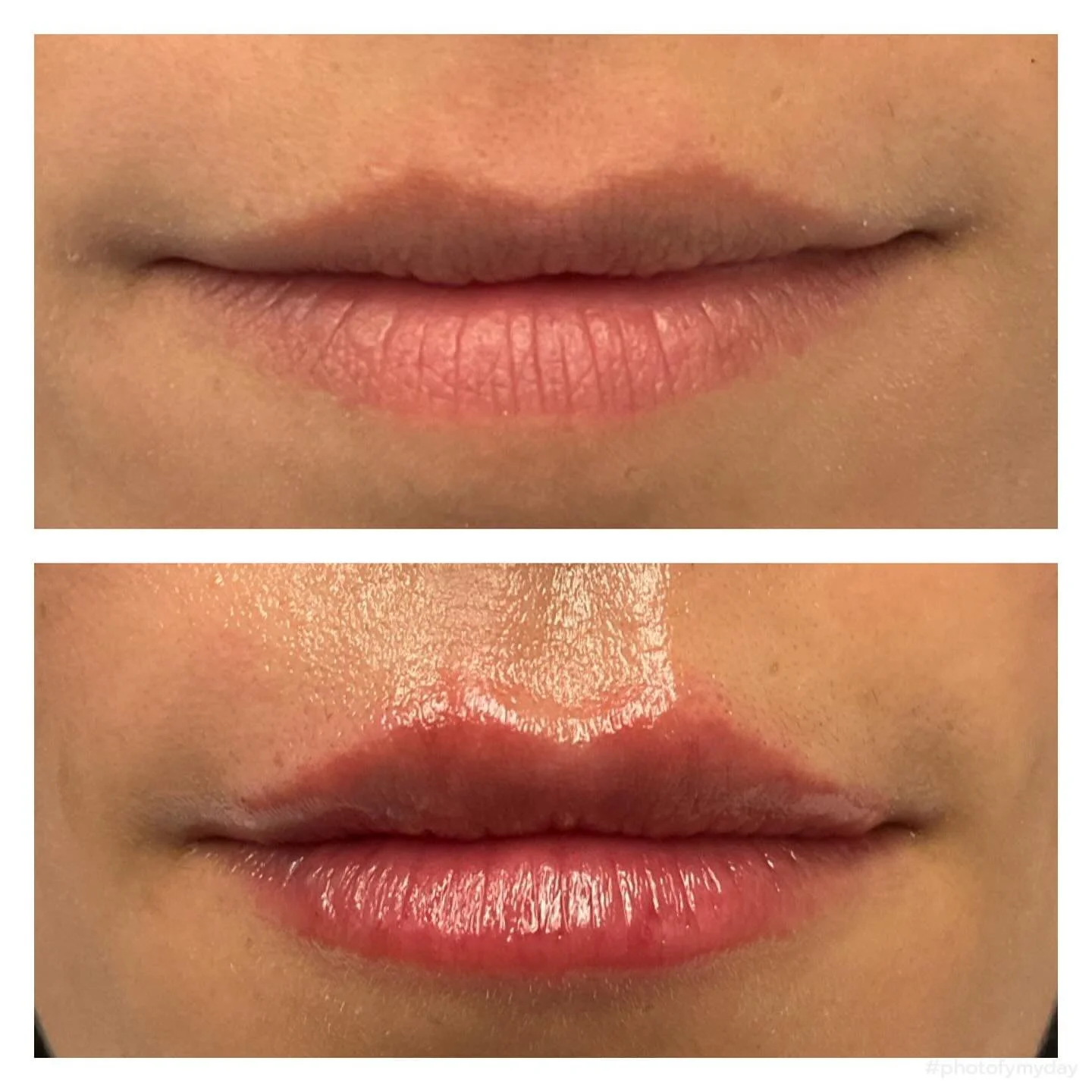 ✨ Subtle, plump, and beautifully natural.
Each slide tells a story &mdash; from immediate post-treatment to several weeks later, when swelling settles and the shape refines into soft, balanced volume. 💋

Consistency and artistry make all the differe