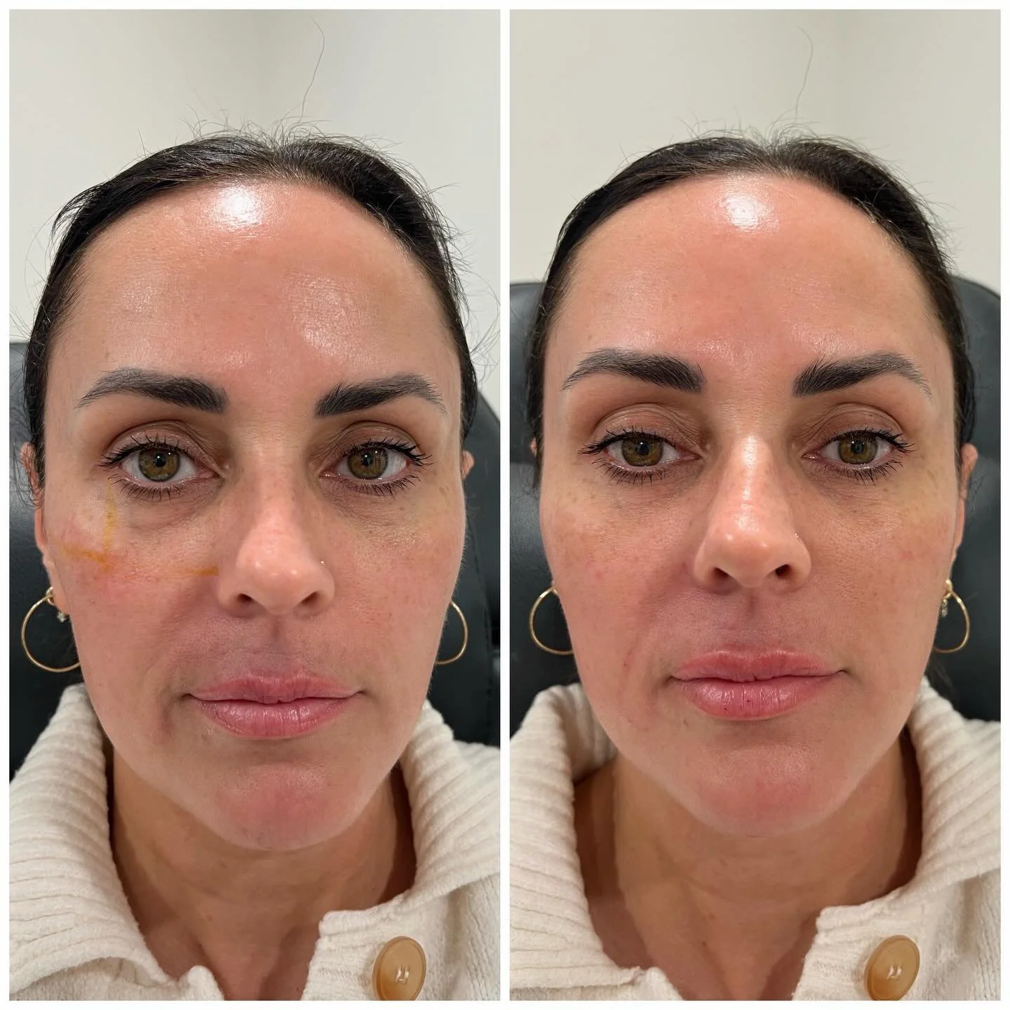 A little love in all the right places ✨
Cheeks and cheekbones for gentle lift, a touch in the right piriform, and the tiniest bit of lip filler for balance 💋

👀 Notice how her eyes look brighter and less hollow &mdash; that rested, refreshed glow w