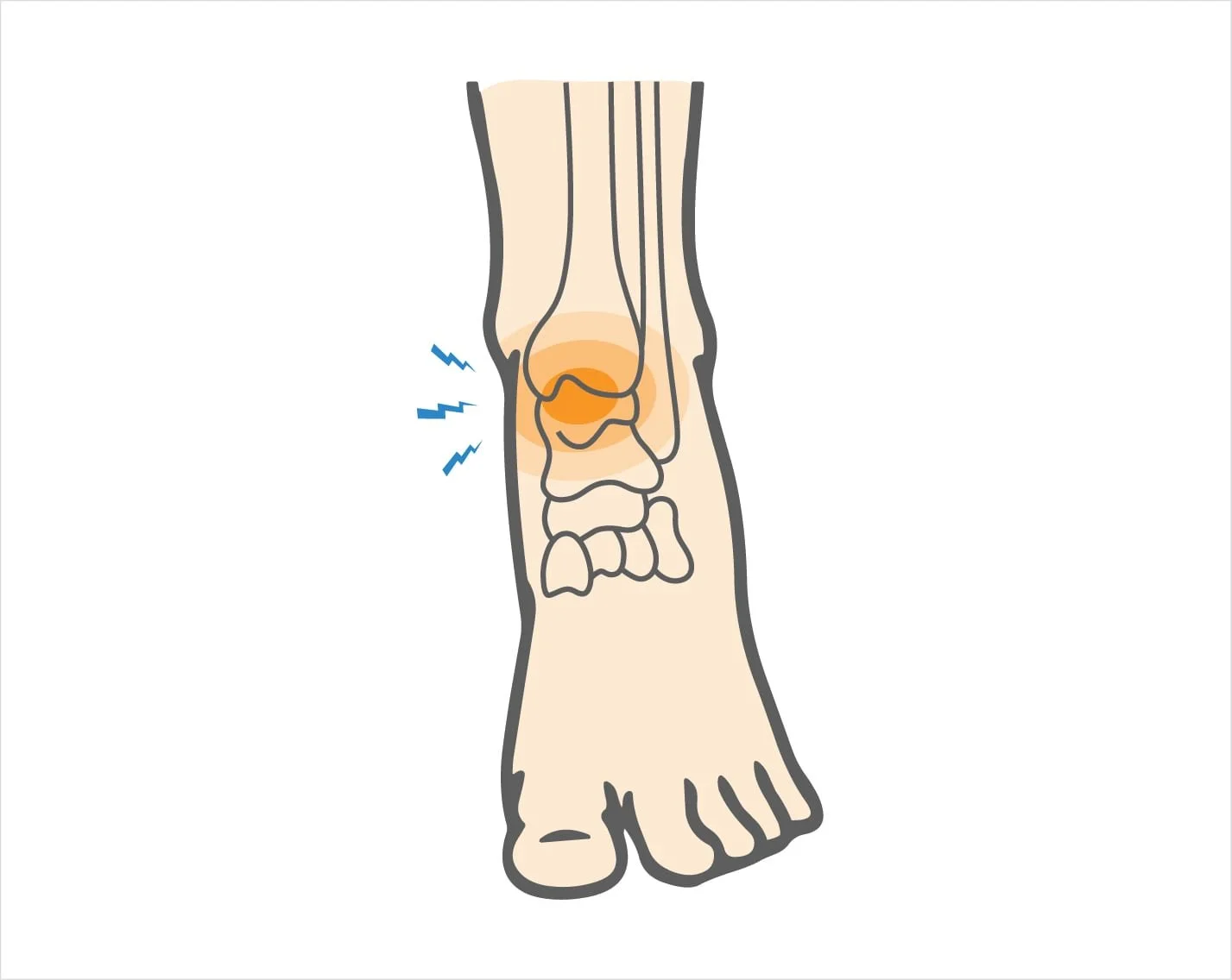 Osteochondral injury ankle