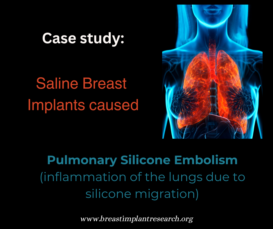 Pulmonary Silicone Embolism
