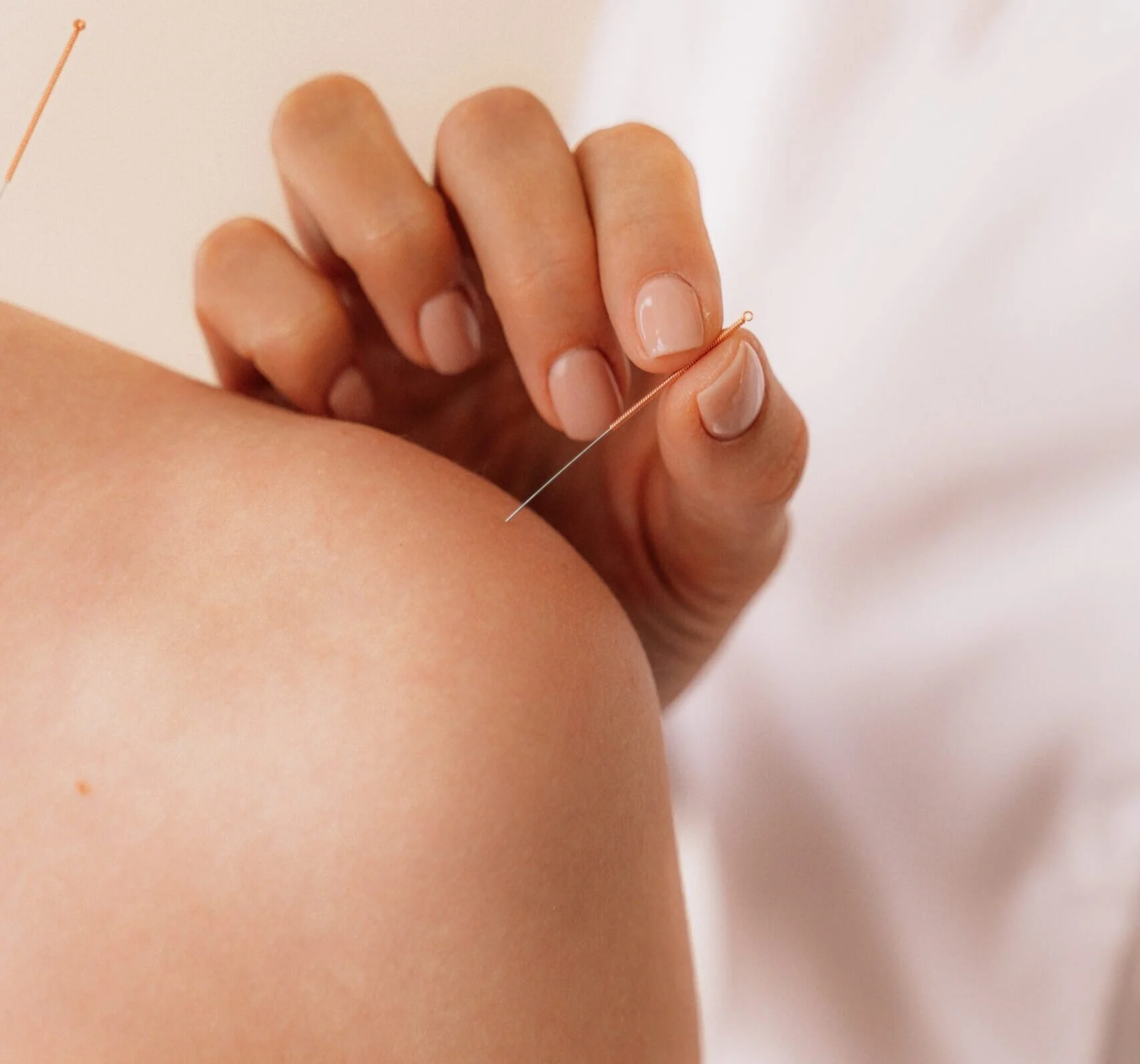 Close-up of acupuncture needles being inserted into a person's shoulder by a hand.