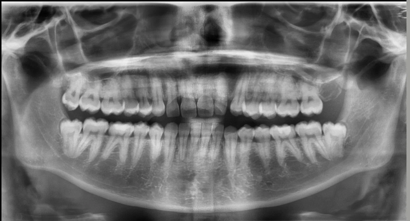 An x-ray photo of an adult jaw in black and white.