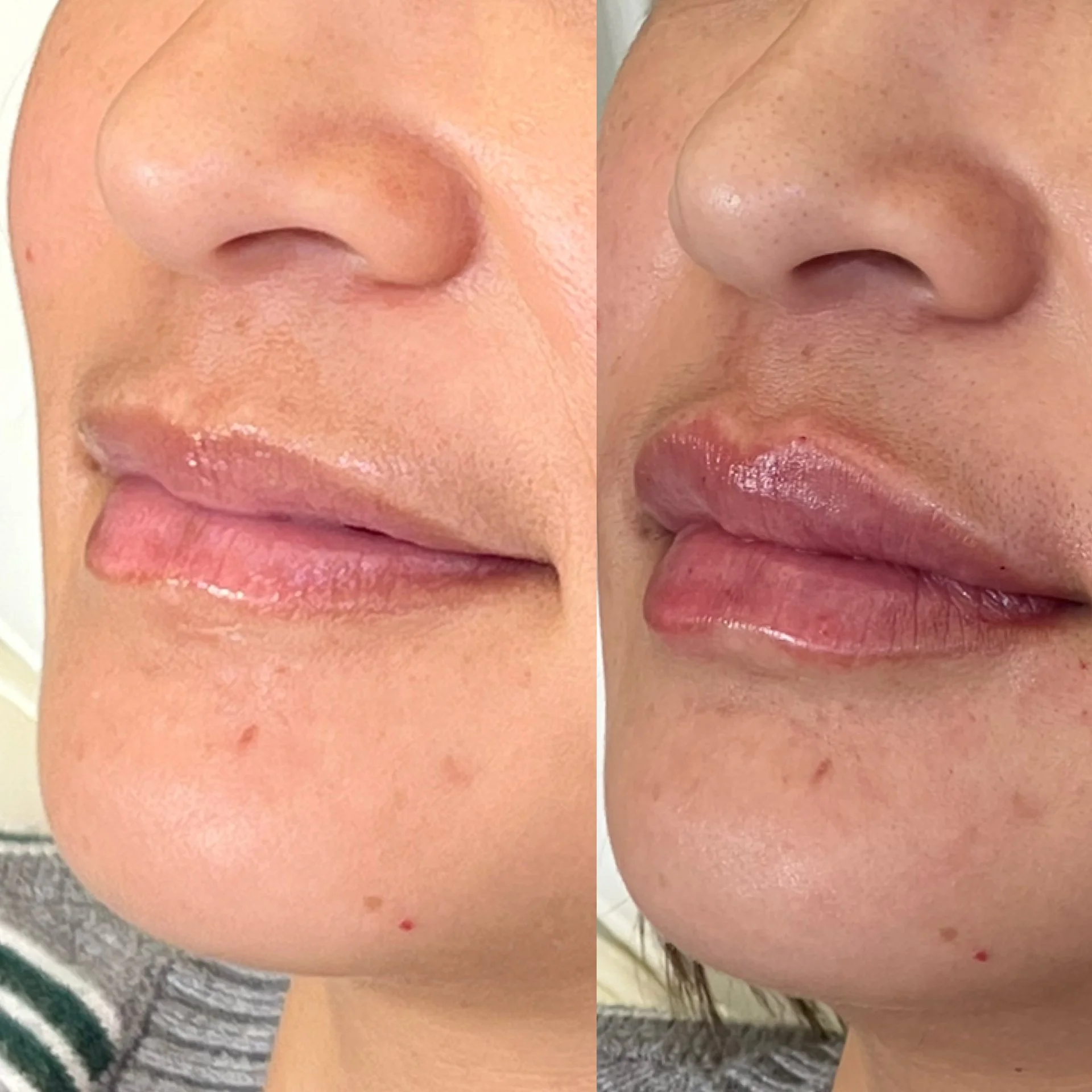 SKINVIVE by JUVÉDERM®