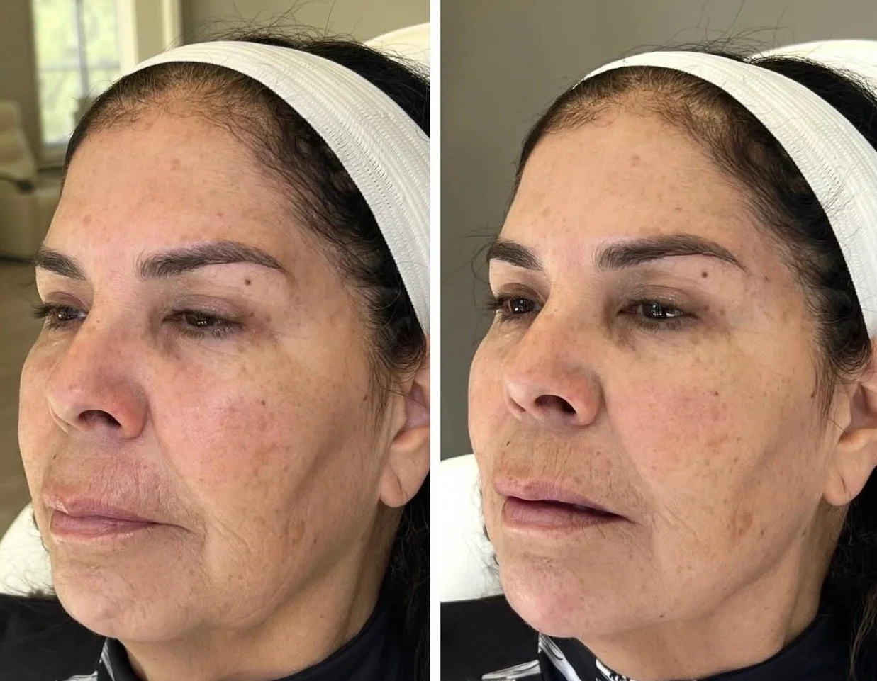 Dermal Filler