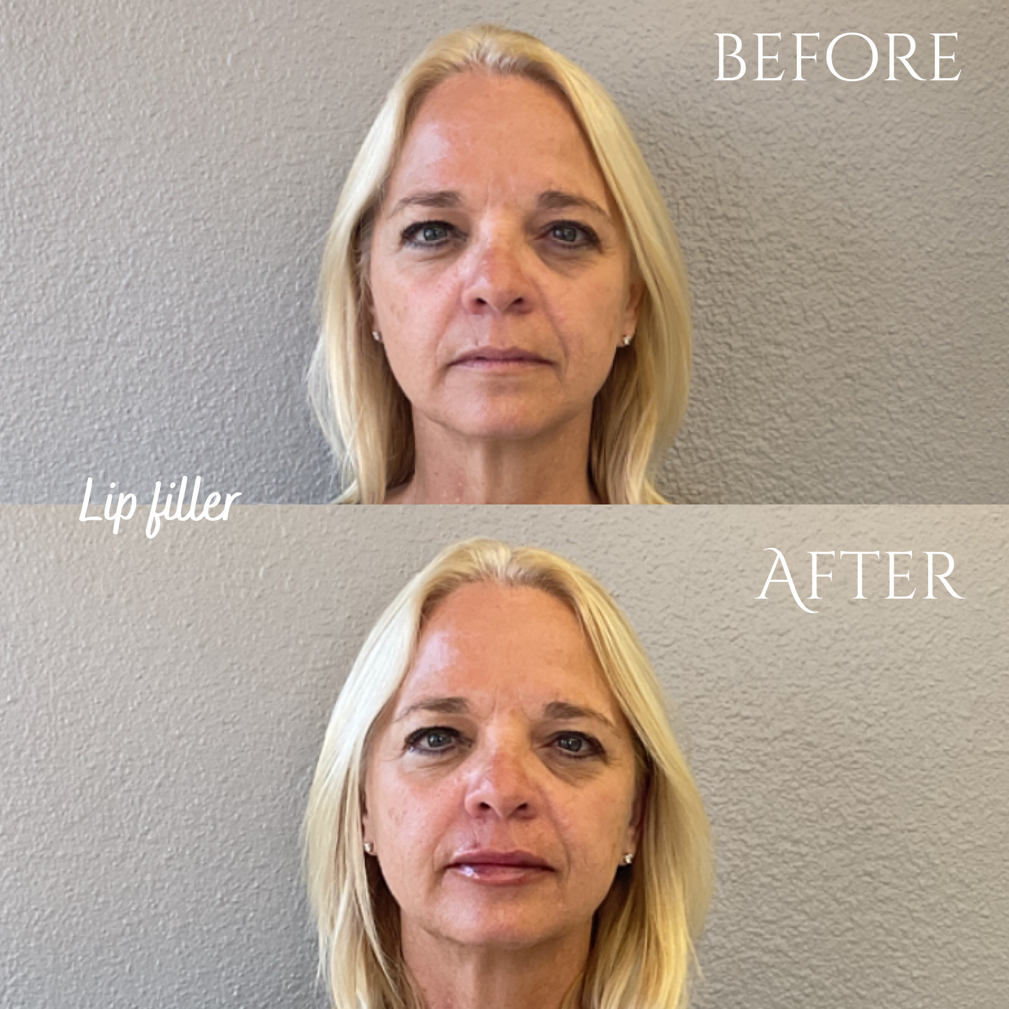 SM Bef:Aft lip filler.PNG