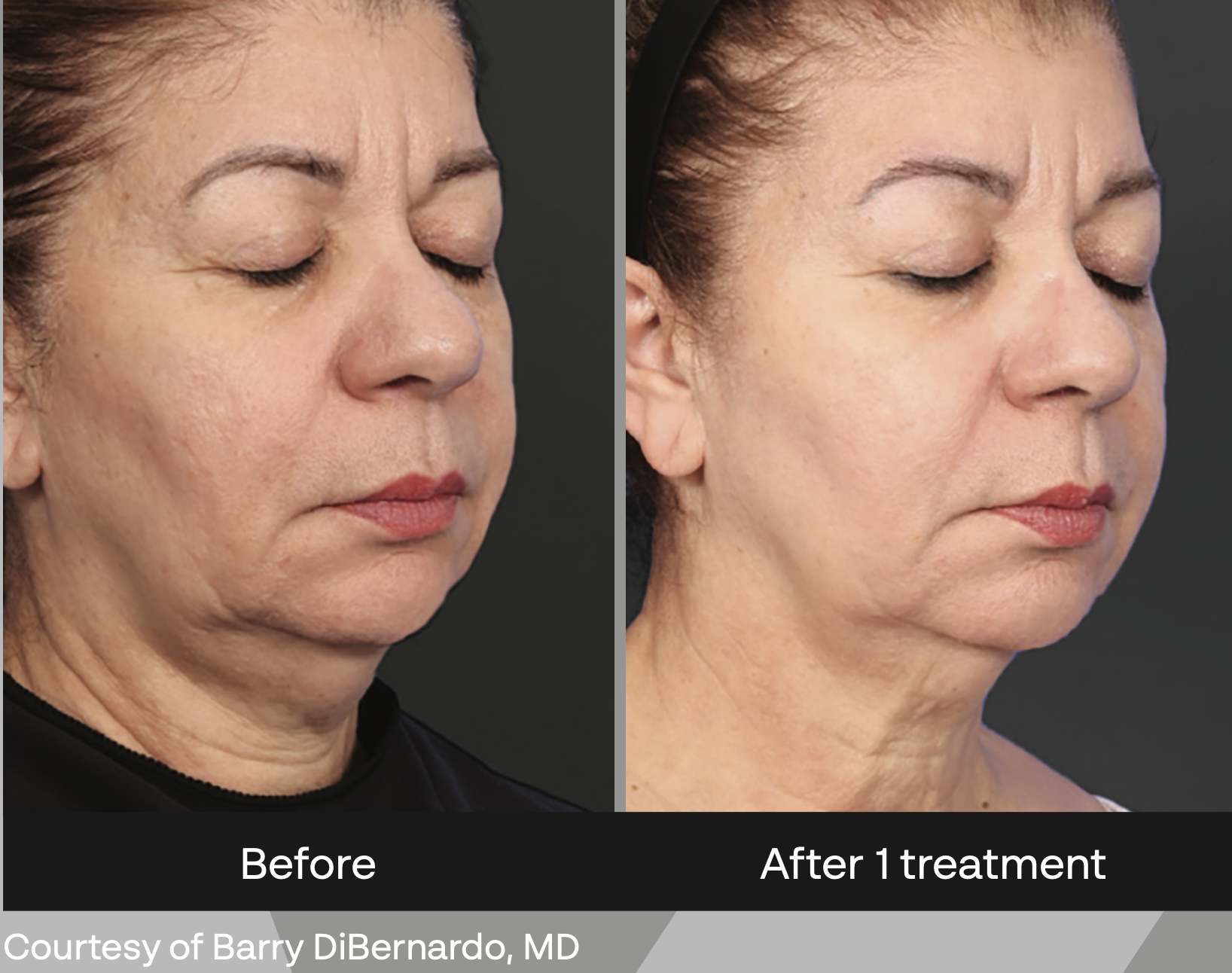 XERF radiofrequency skin tightening jawline results