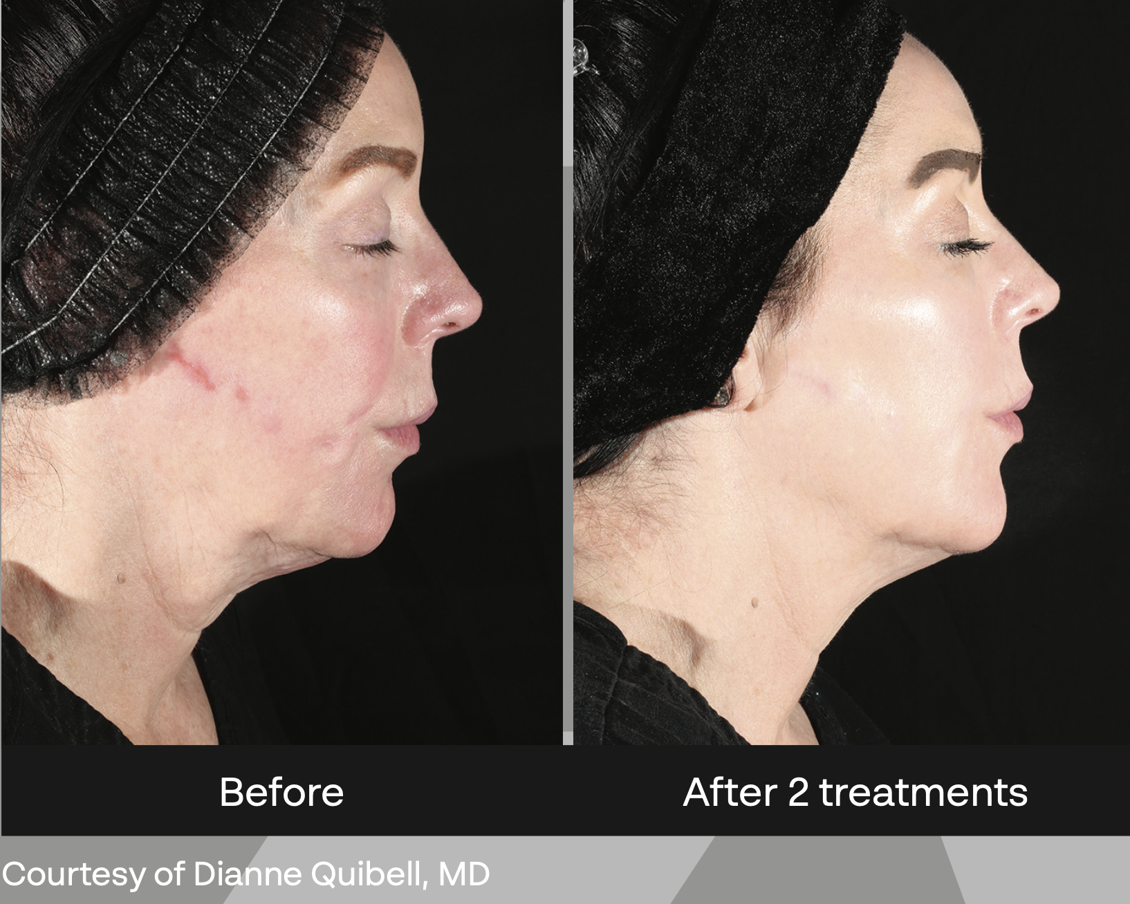 XERF radiofrequency skin neck tightening results