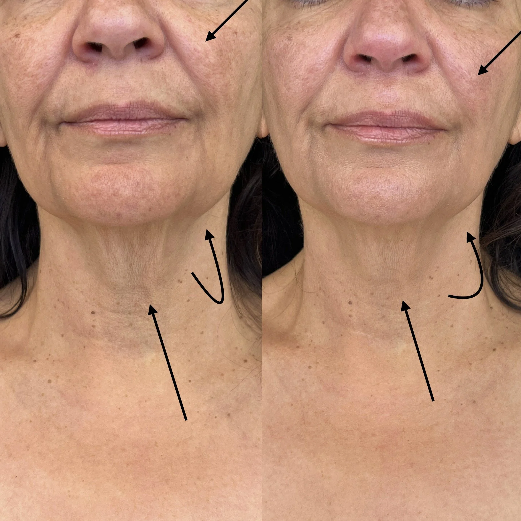Xerf Skin Tigthening