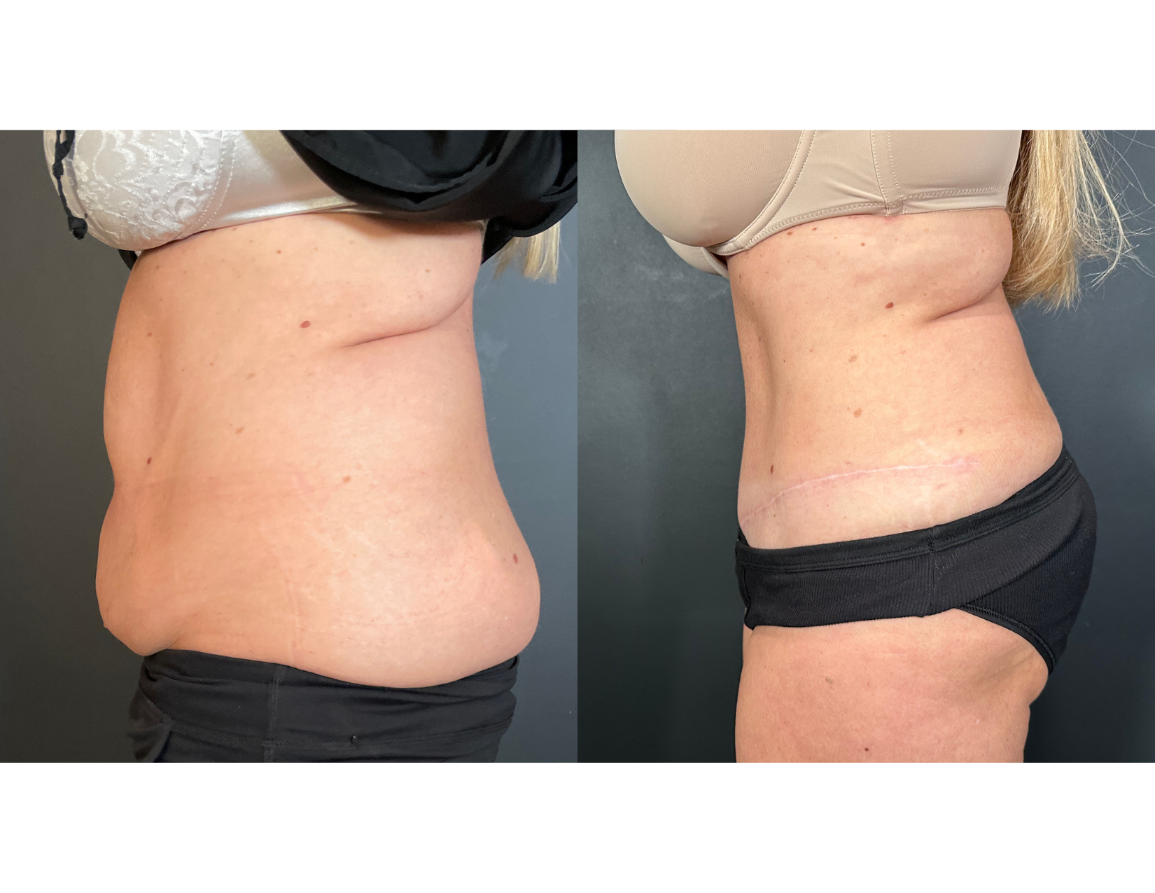 3 months post OP aBDOMINOPLASTY WITH LIPOSUCTION (52).png