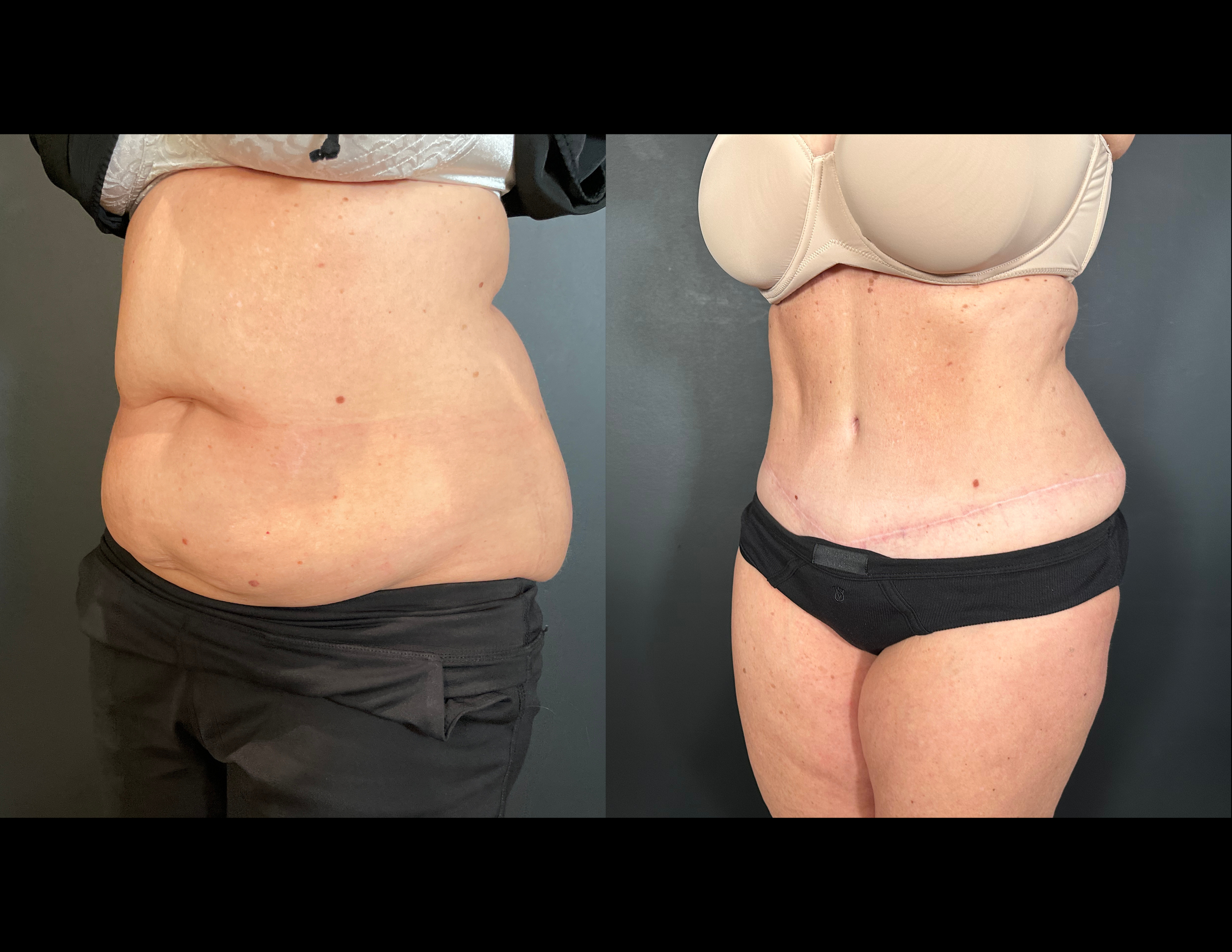 3 months post OP aBDOMINOPLASTY WITH LIPOSUCTION (48).png