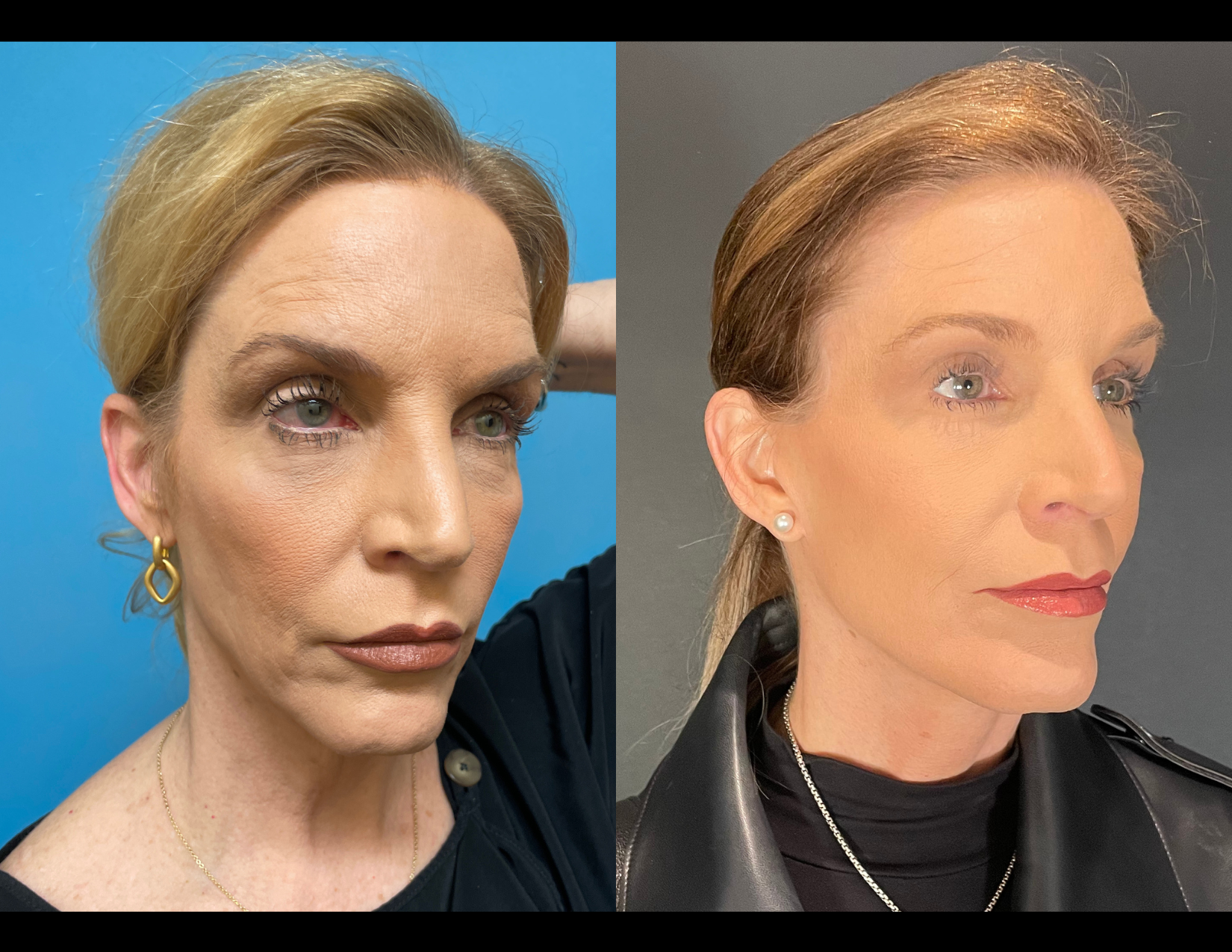 3 months post OP aBDOMINOPLASTY WITH LIPOSUCTION (14).png