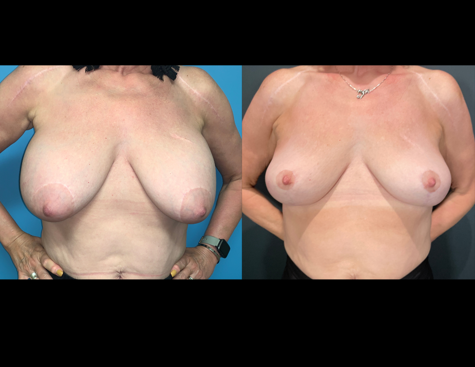 3 months post OP aBDOMINOPLASTY WITH LIPOSUCTION (31).png