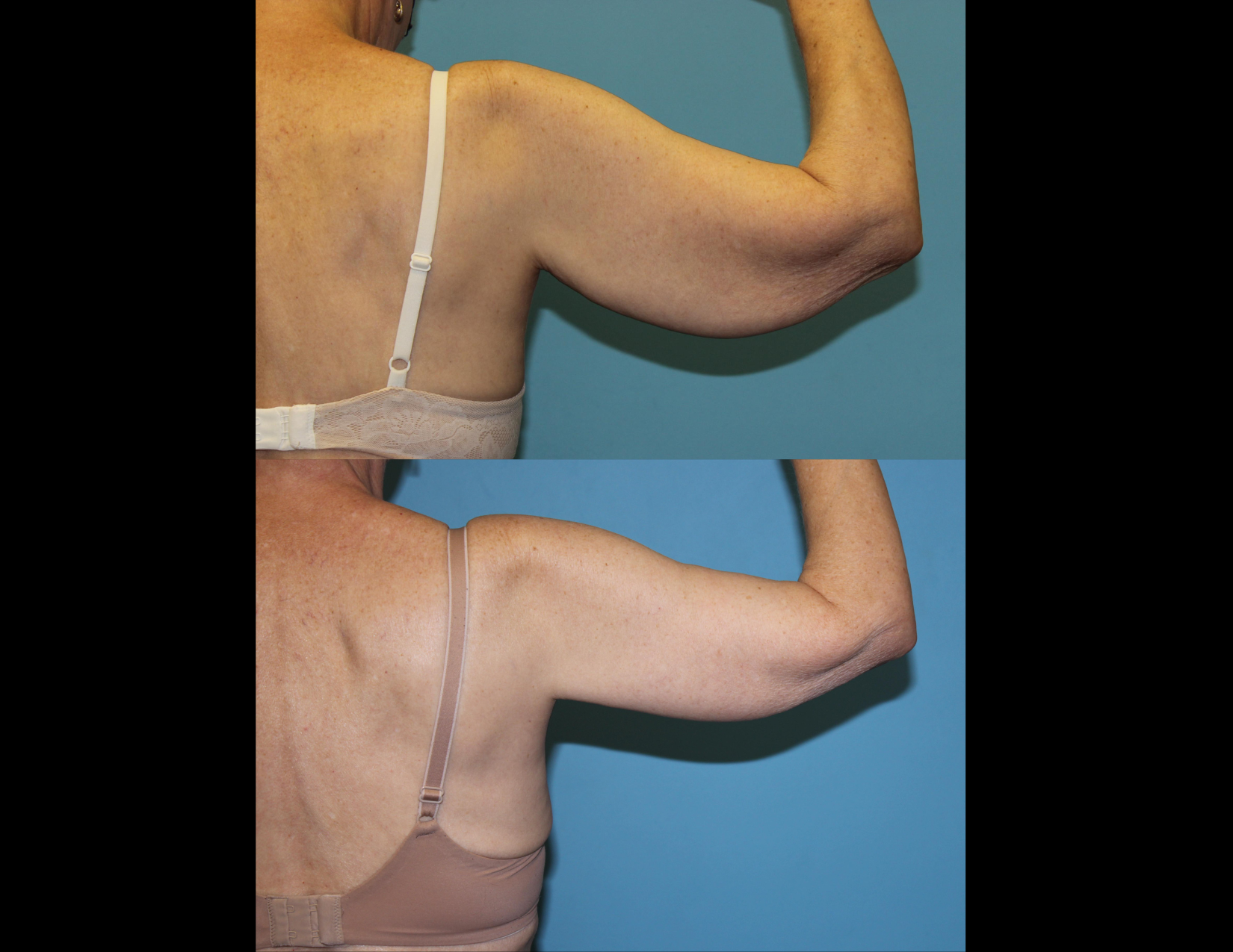 3 months post OP aBDOMINOPLASTY WITH LIPOSUCTION (21).png