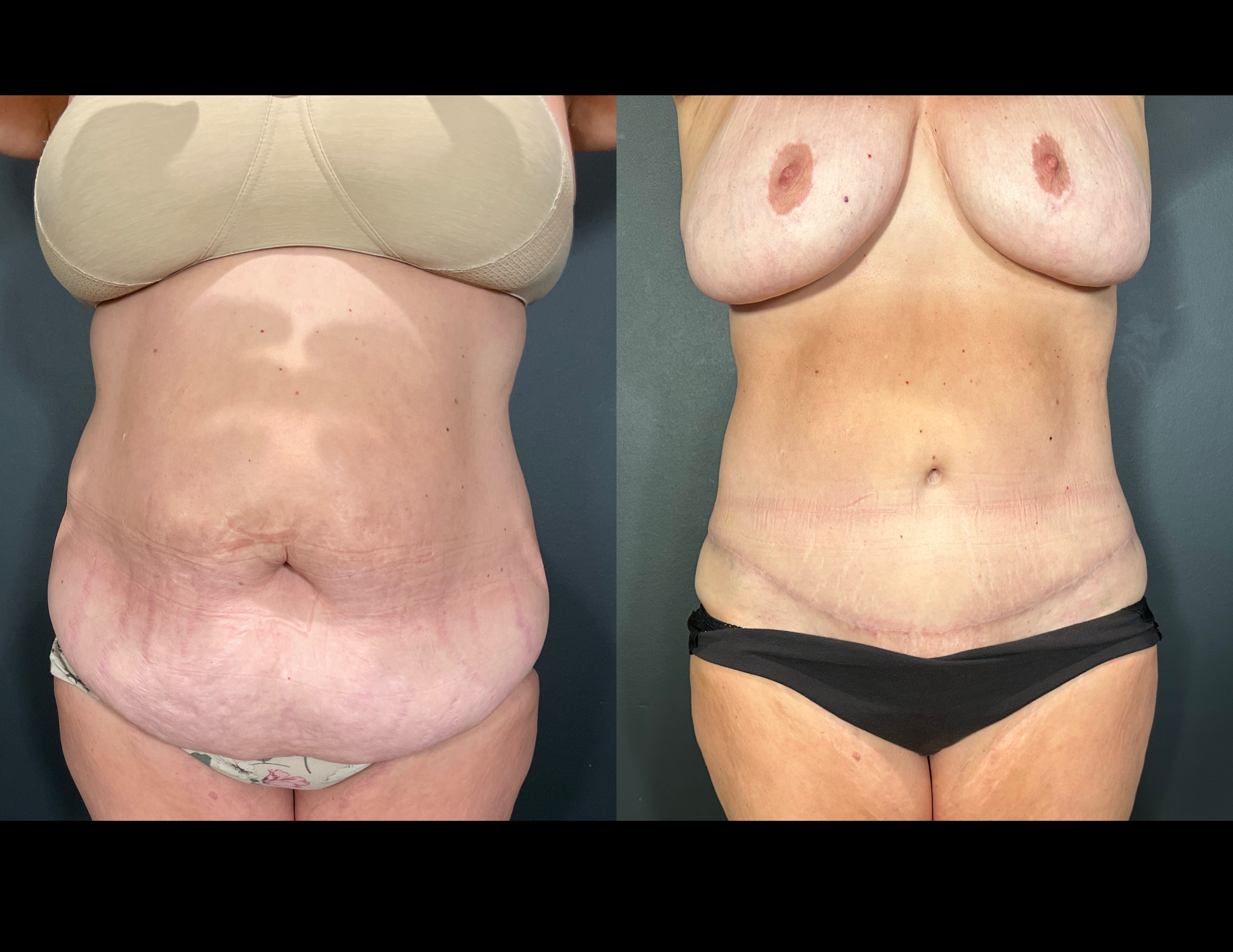 3 months post OP aBDOMINOPLASTY WITH LIPOSUCTION (45).png