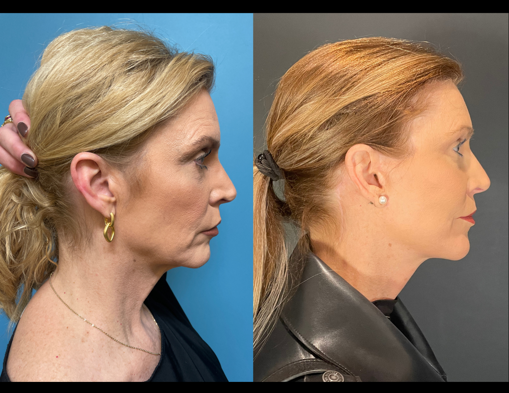 3 months post OP aBDOMINOPLASTY WITH LIPOSUCTION (15).png
