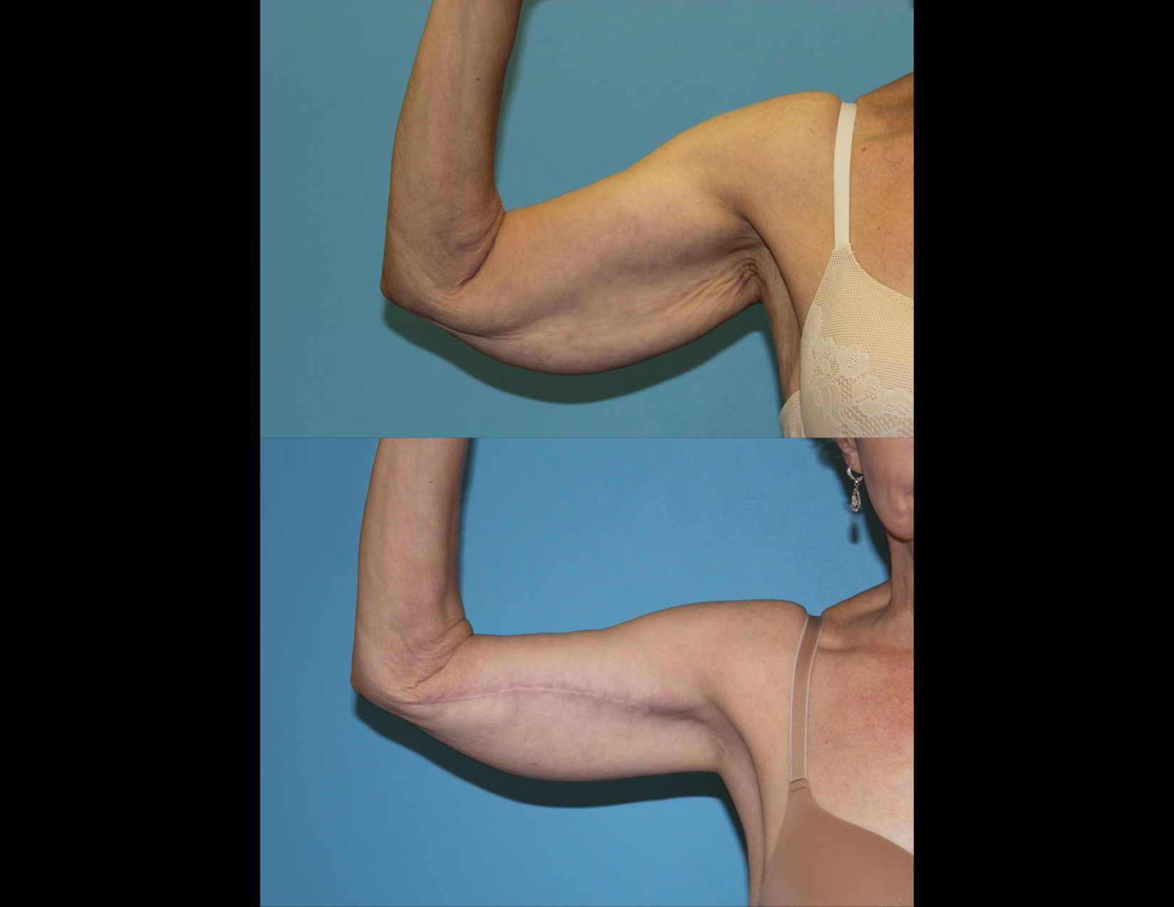 3 months post OP aBDOMINOPLASTY WITH LIPOSUCTION (22).png