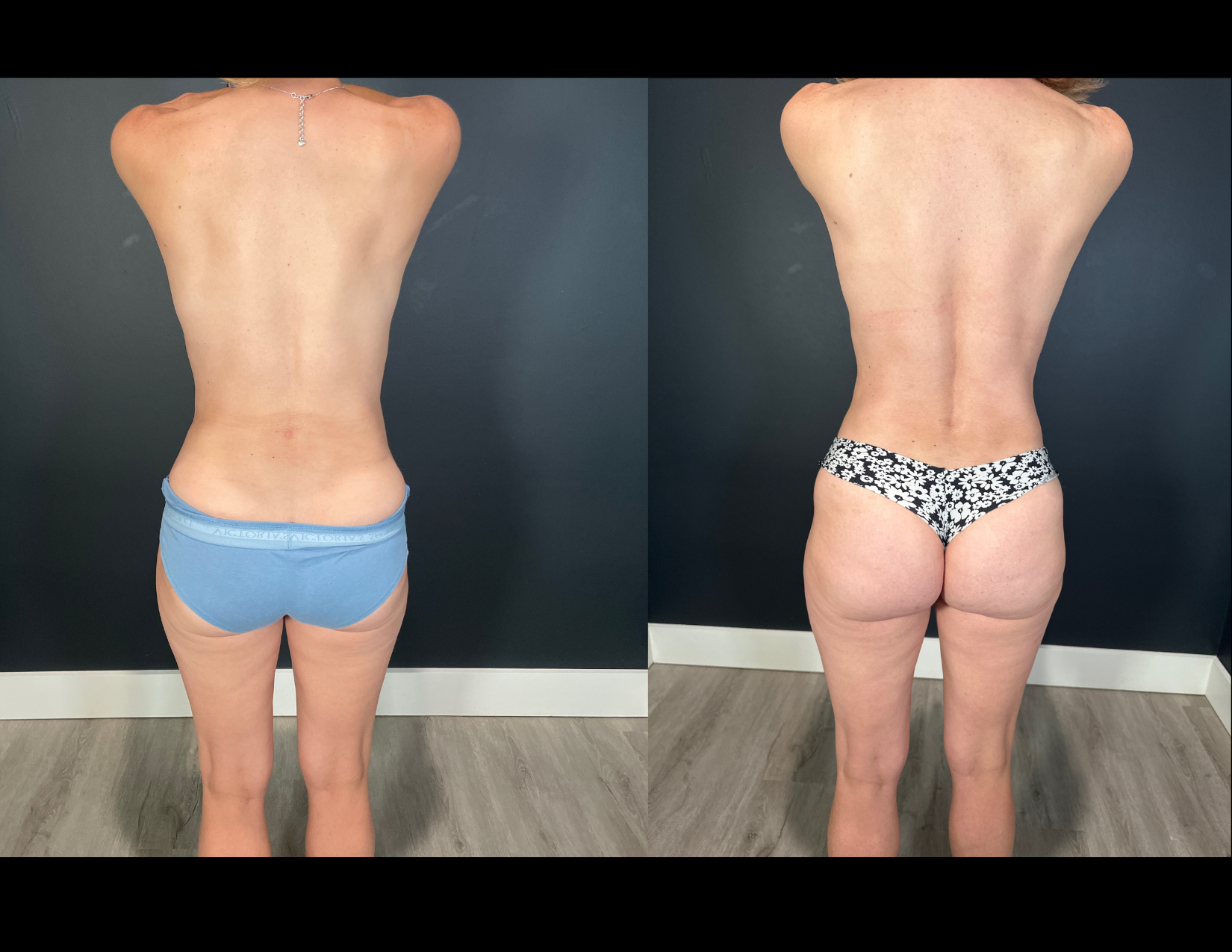 3 months post OP aBDOMINOPLASTY WITH LIPOSUCTION (44).png