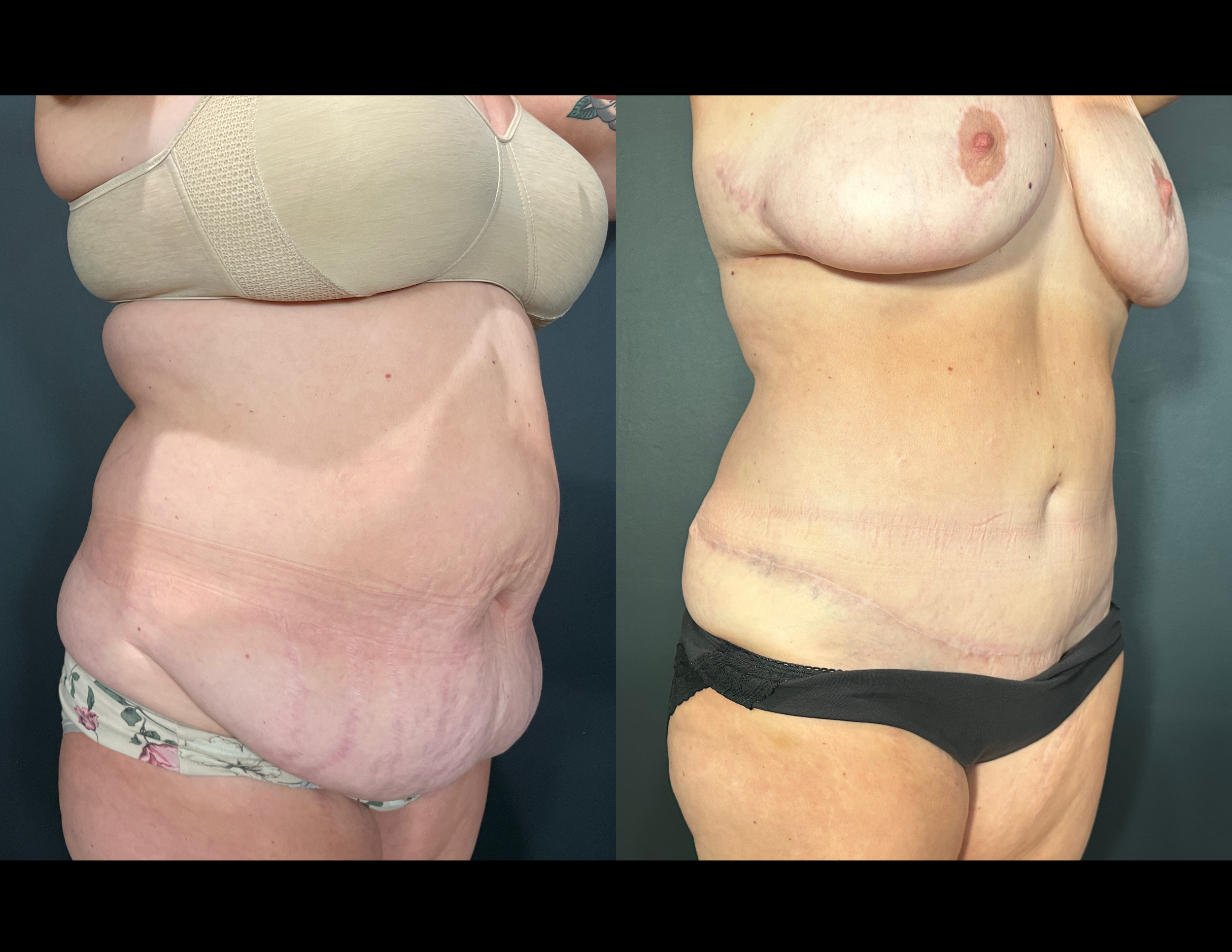 3 months post OP aBDOMINOPLASTY WITH LIPOSUCTION (46).png