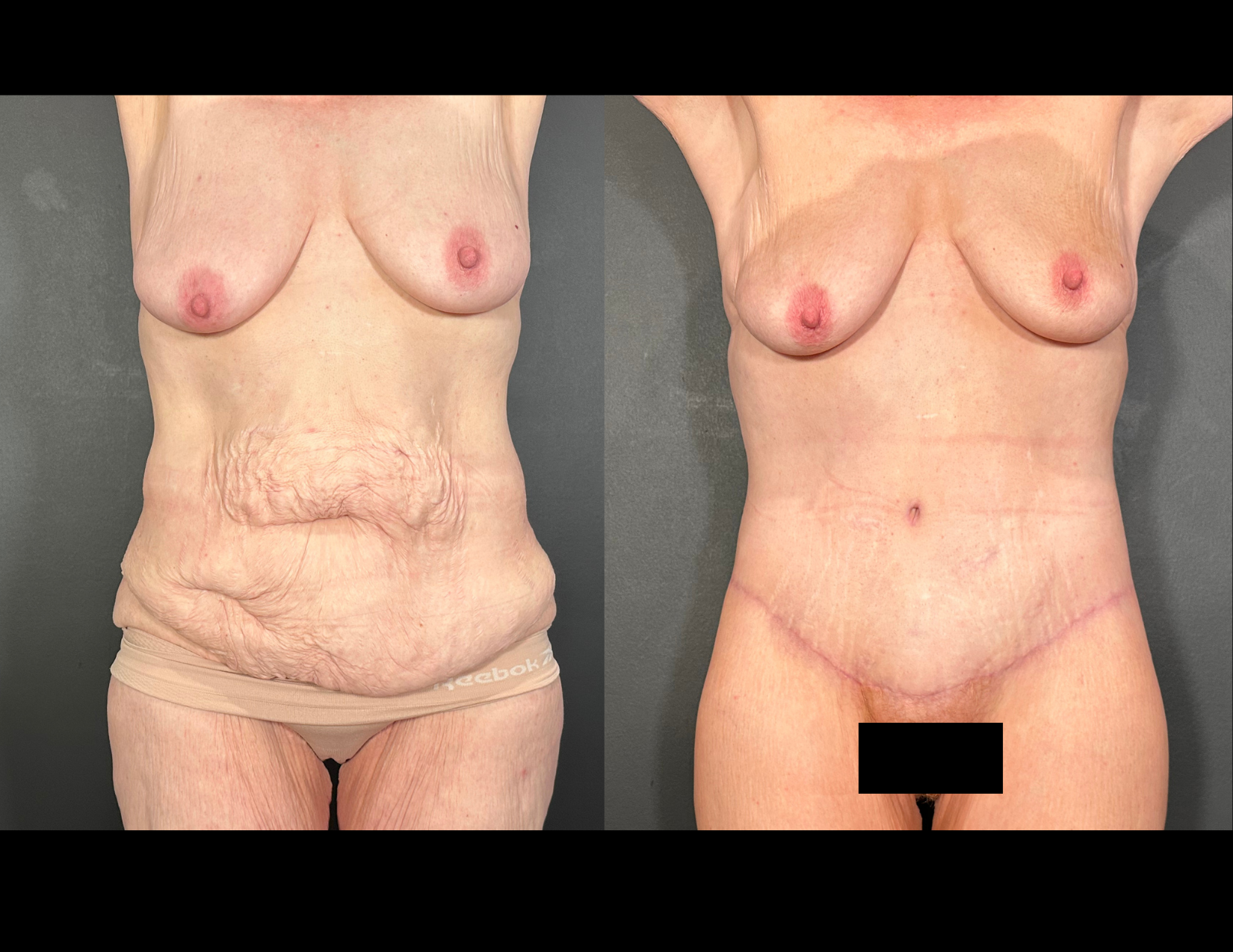 3 months post OP aBDOMINOPLASTY WITH LIPOSUCTION (38).png
