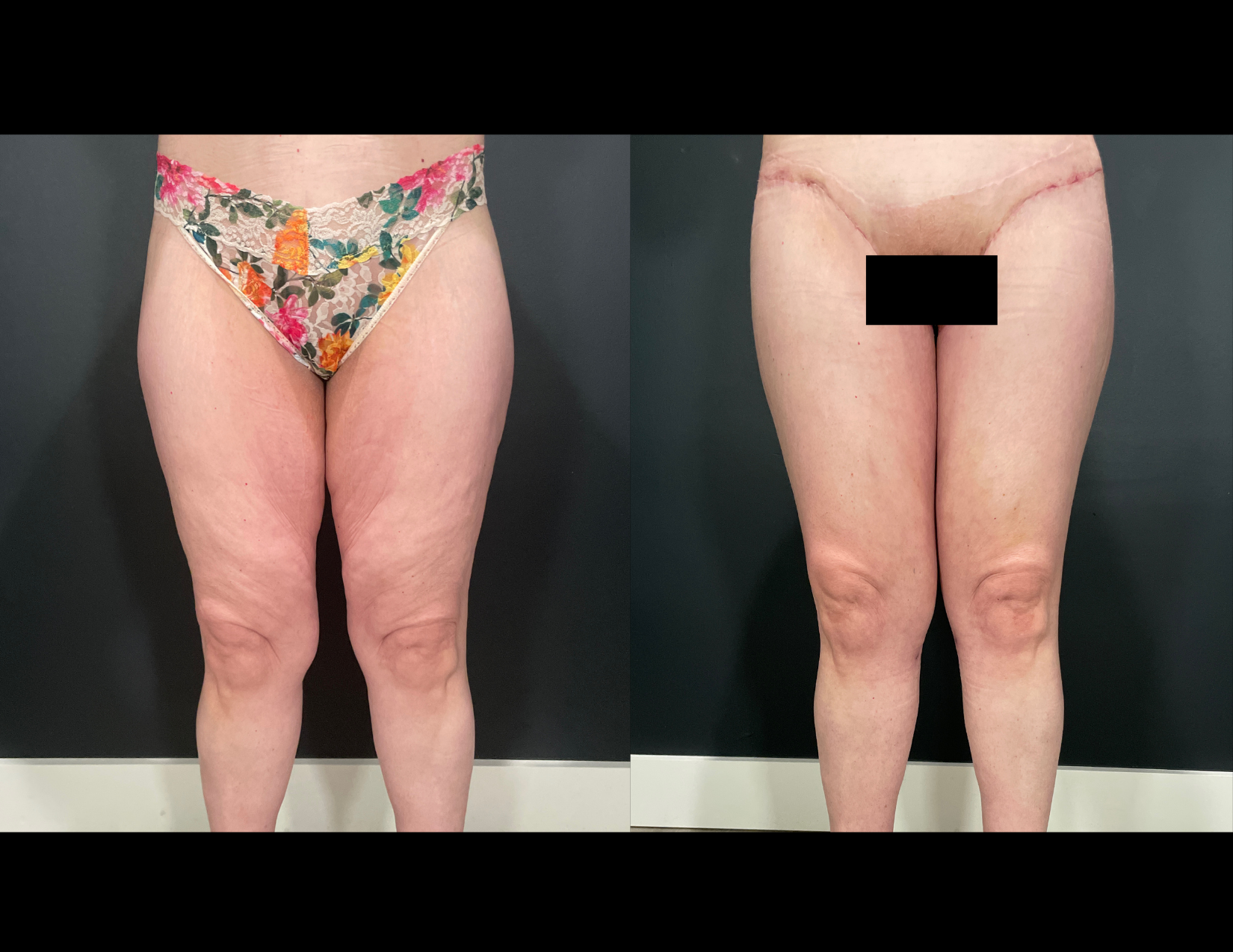 3 months post OP aBDOMINOPLASTY WITH LIPOSUCTION (8).png