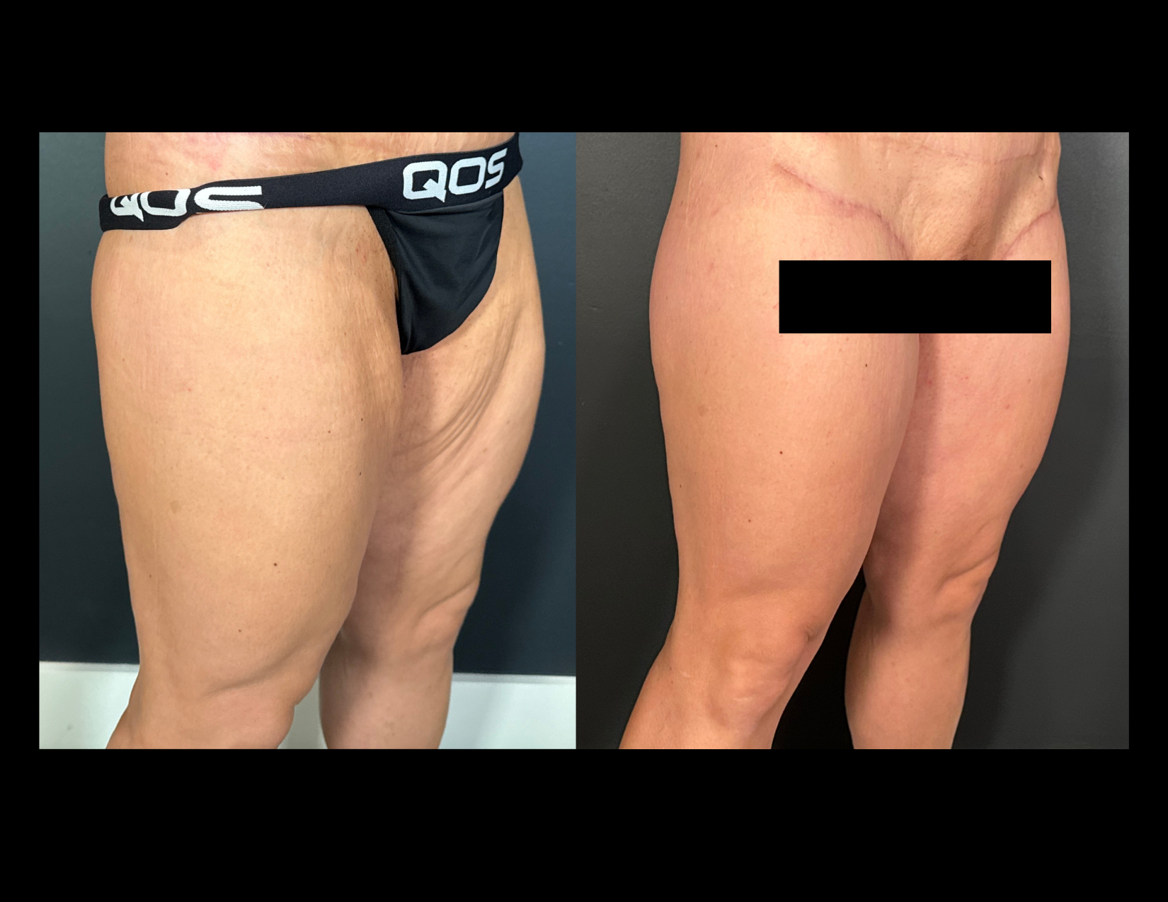 3 months post OP aBDOMINOPLASTY WITH LIPOSUCTION (3).png