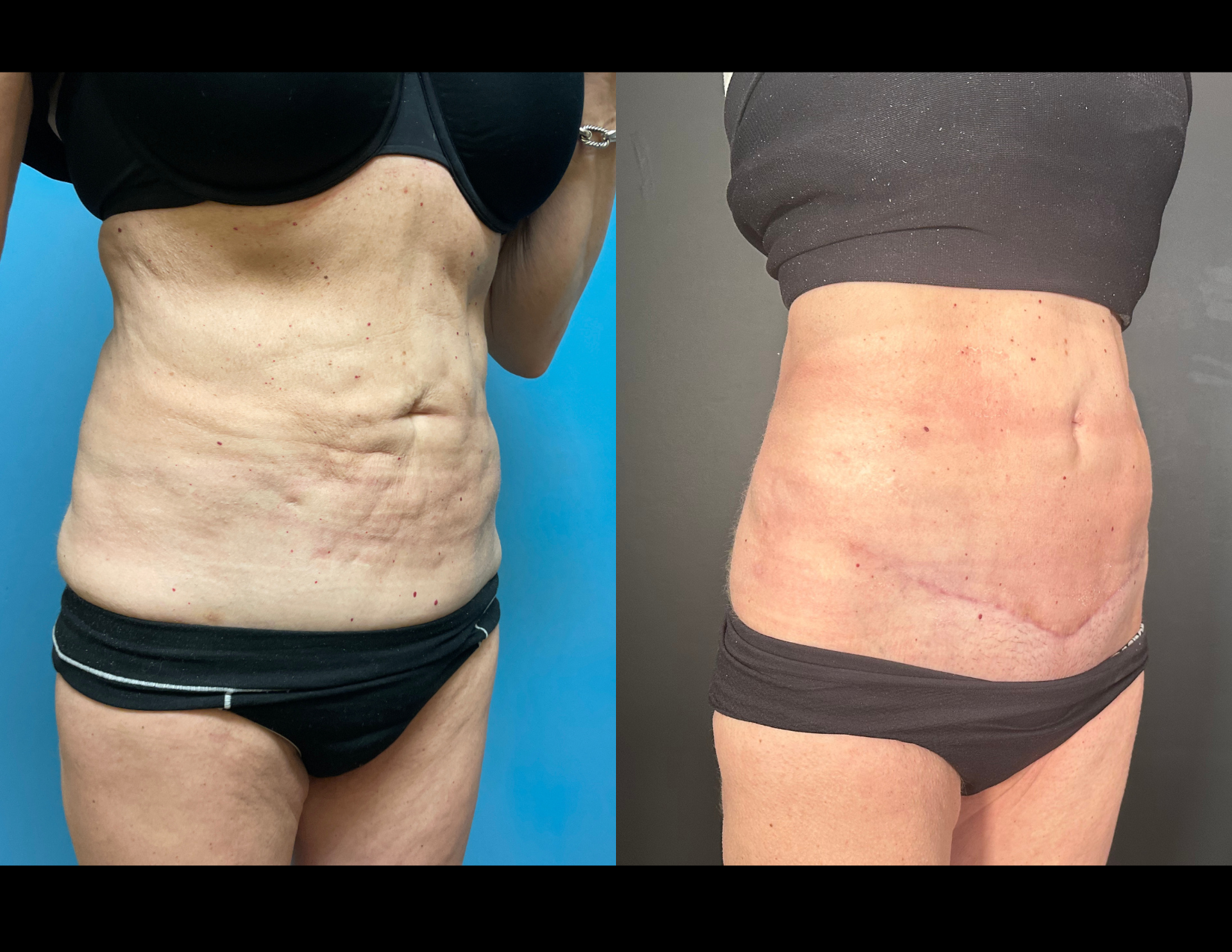 3 months post OP aBDOMINOPLASTY WITH LIPOSUCTION (11).png