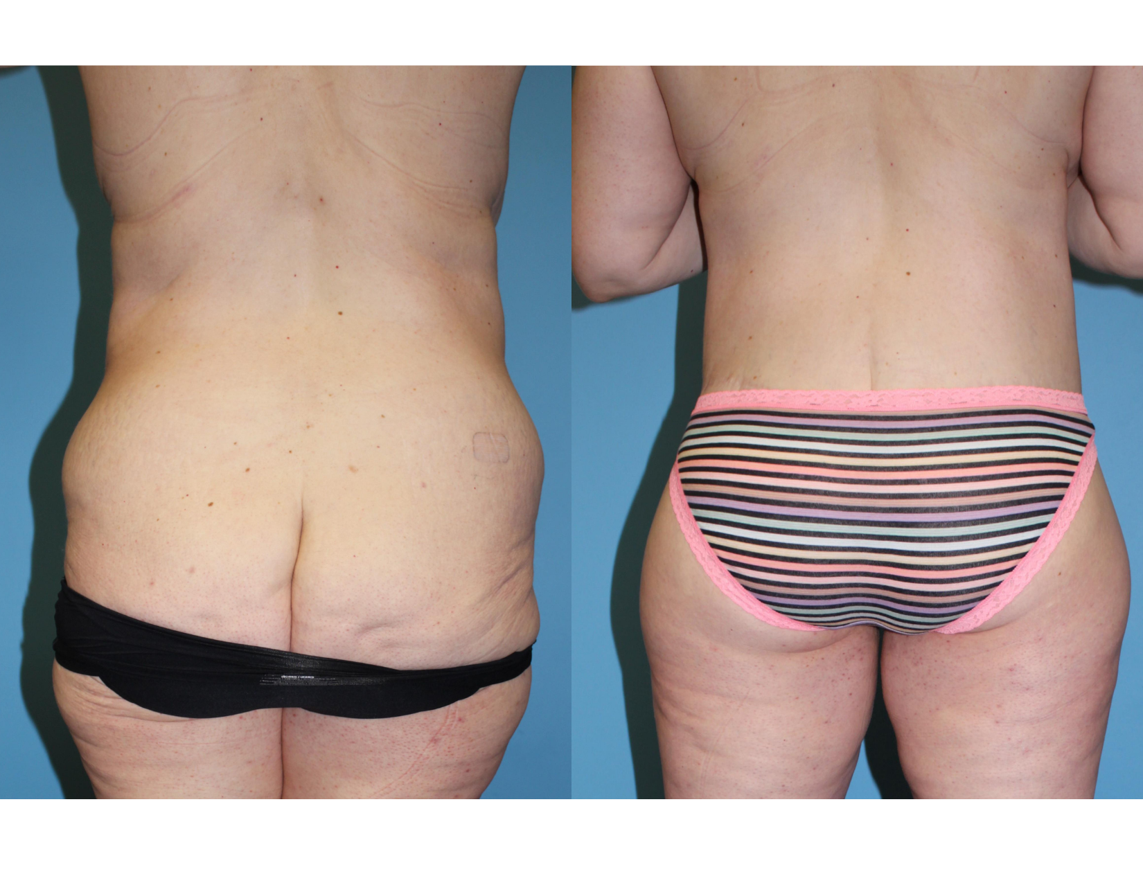 3 months post OP aBDOMINOPLASTY WITH LIPOSUCTION (55).png