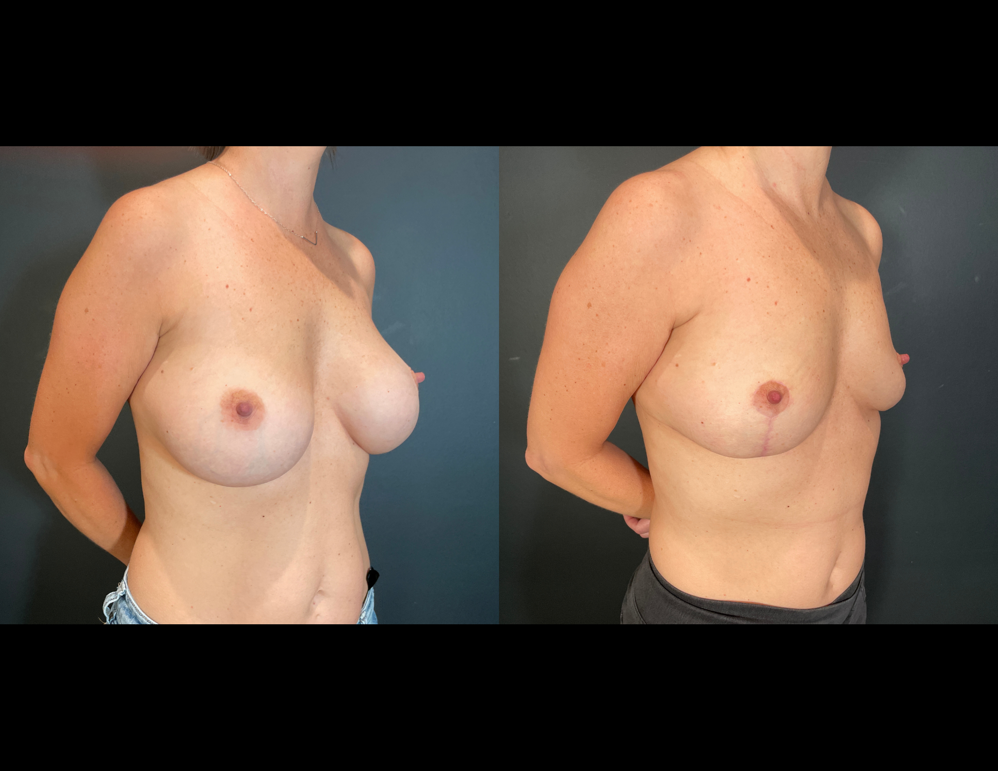Before & After Photos 2(51).png