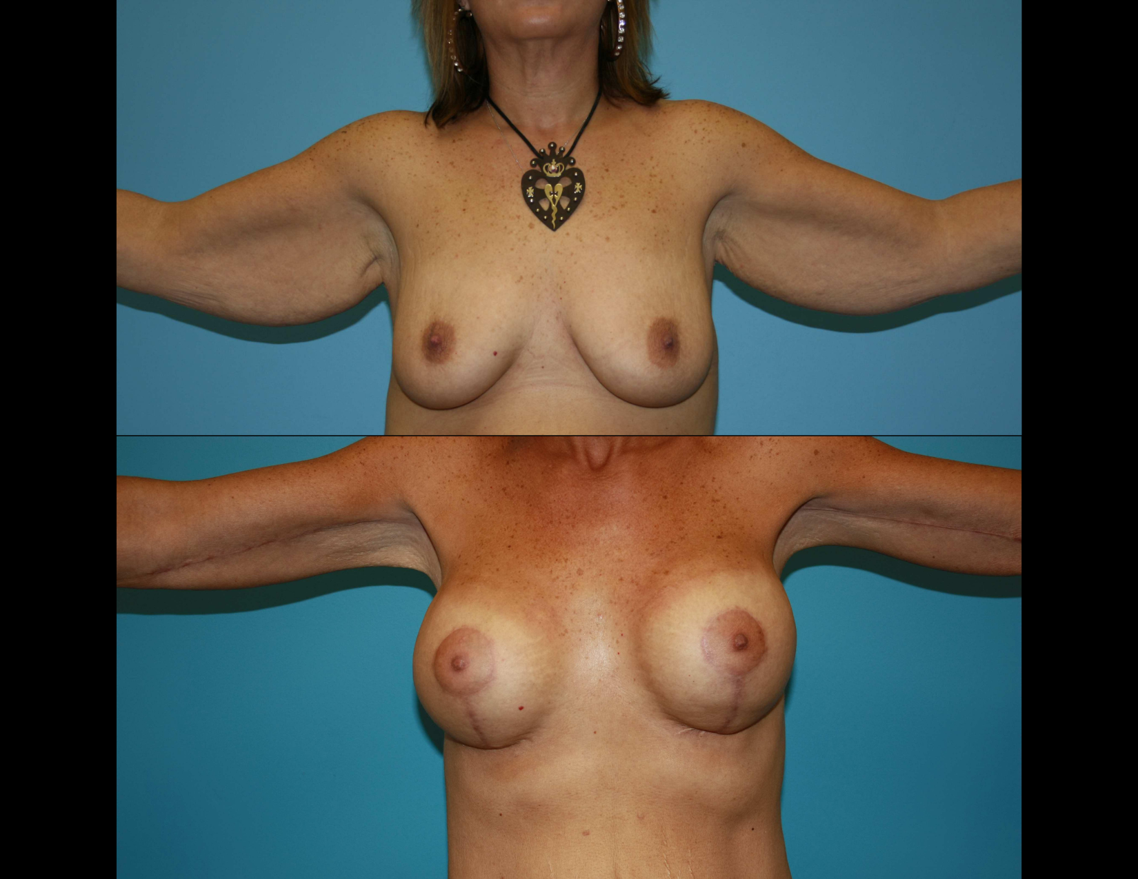3 months post OP aBDOMINOPLASTY WITH LIPOSUCTION (20).png
