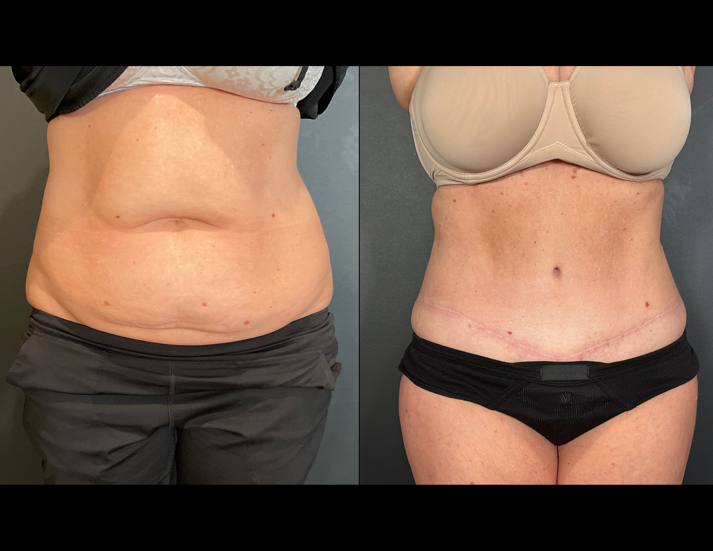 3 months post OP aBDOMINOPLASTY WITH LIPOSUCTION (49).png