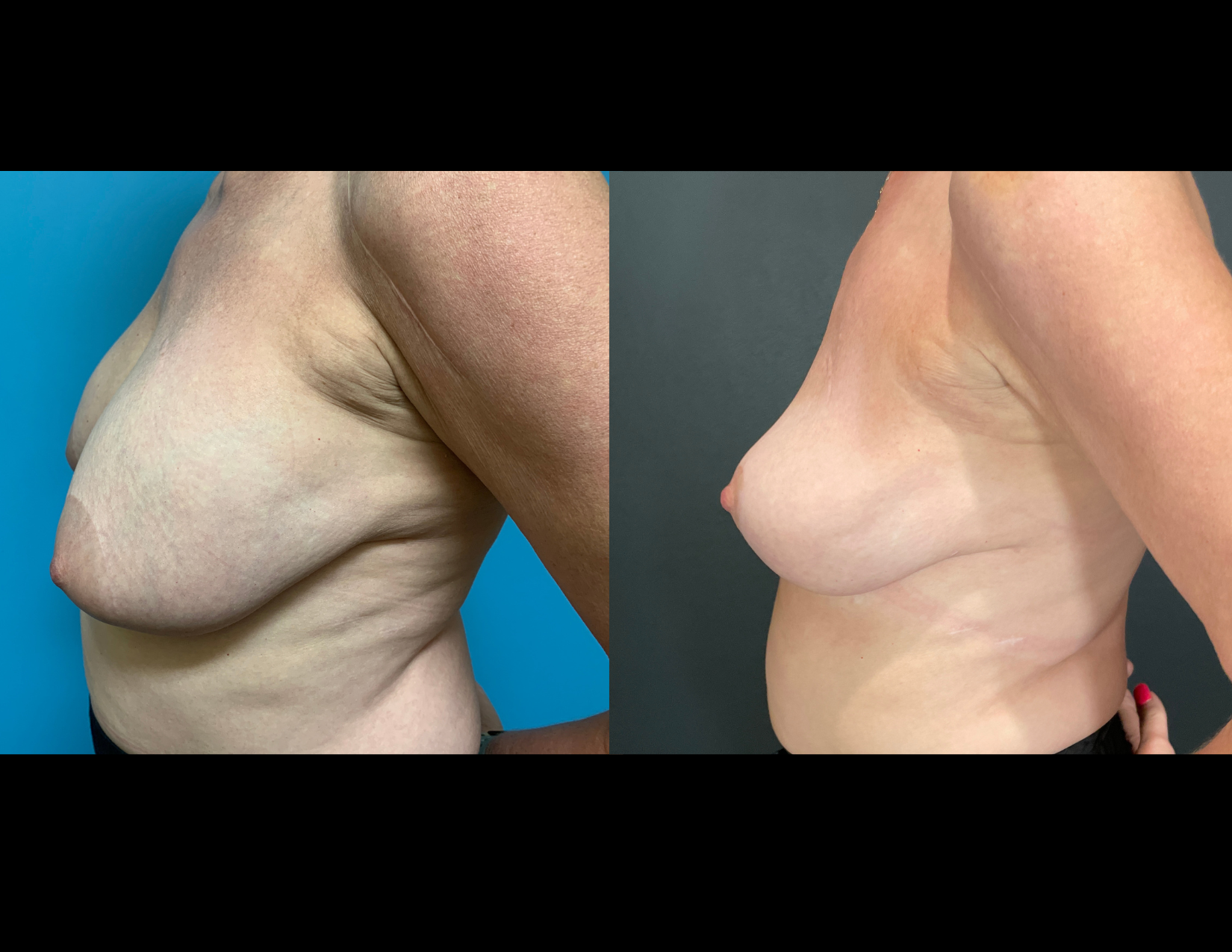 3 months post OP aBDOMINOPLASTY WITH LIPOSUCTION (32).png
