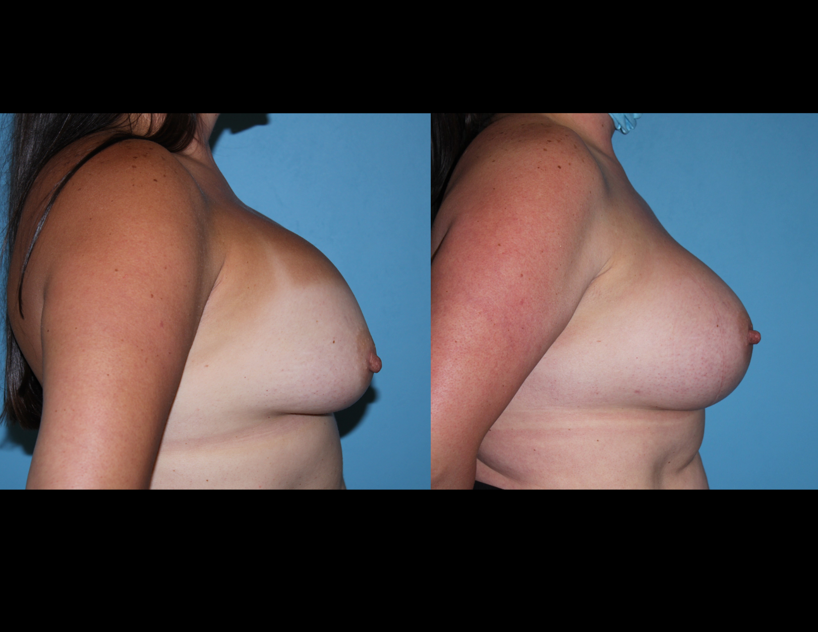 3 months post OP aBDOMINOPLASTY WITH LIPOSUCTION (35).png