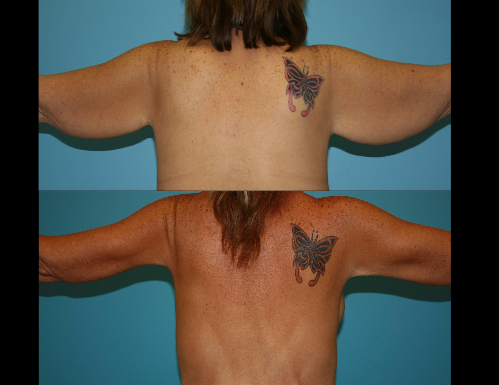 3 months post OP aBDOMINOPLASTY WITH LIPOSUCTION (19).png