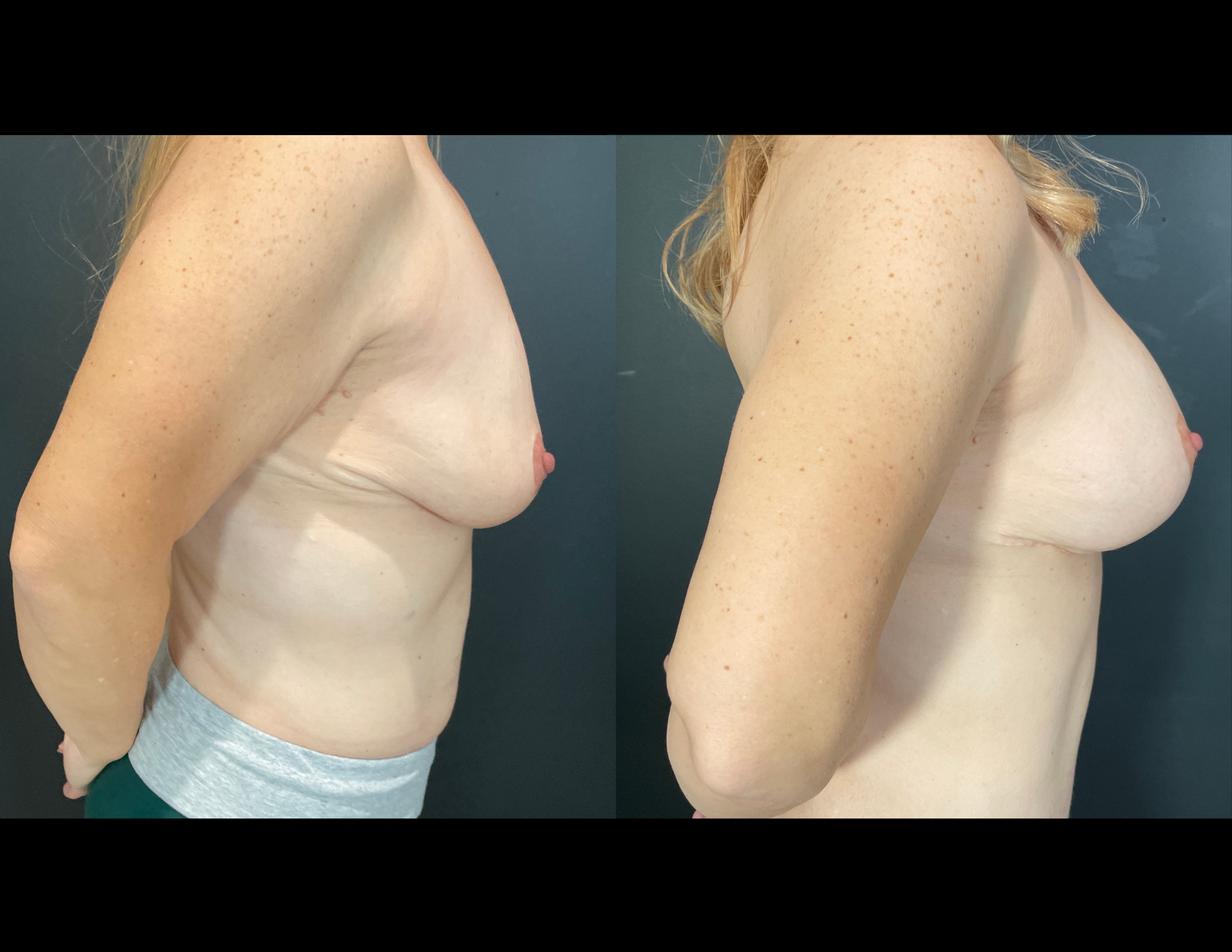 3 months post OP aBDOMINOPLASTY WITH LIPOSUCTION (30).png
