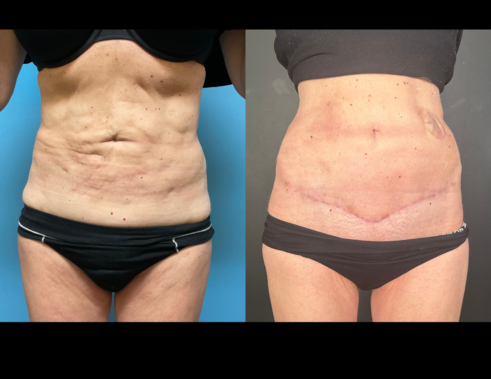 3 months post OP aBDOMINOPLASTY WITH LIPOSUCTION (10).png