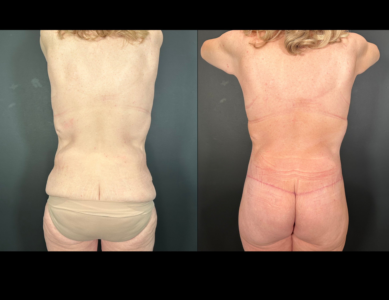 3 months post OP aBDOMINOPLASTY WITH LIPOSUCTION (41).png