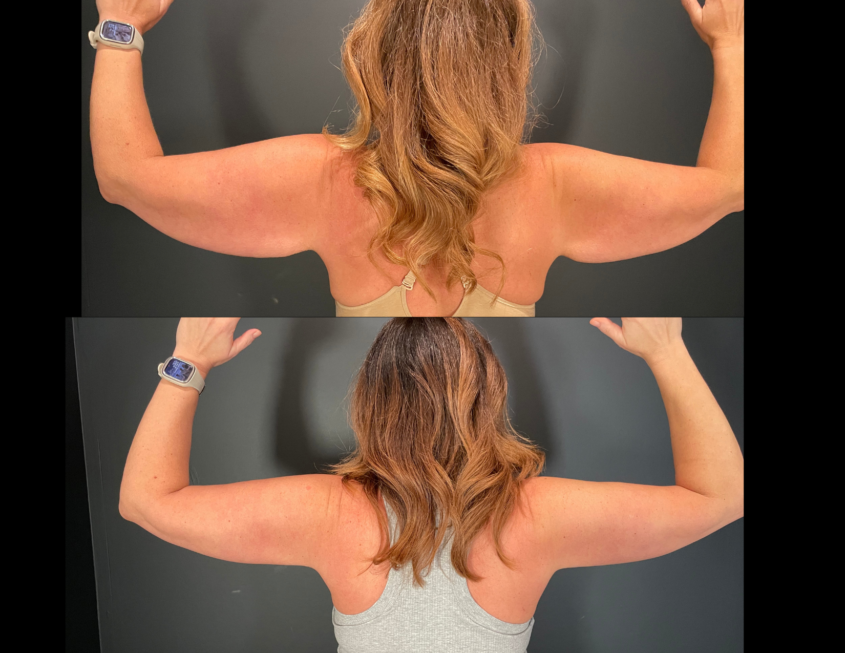 3 months post OP aBDOMINOPLASTY WITH LIPOSUCTION (17).png