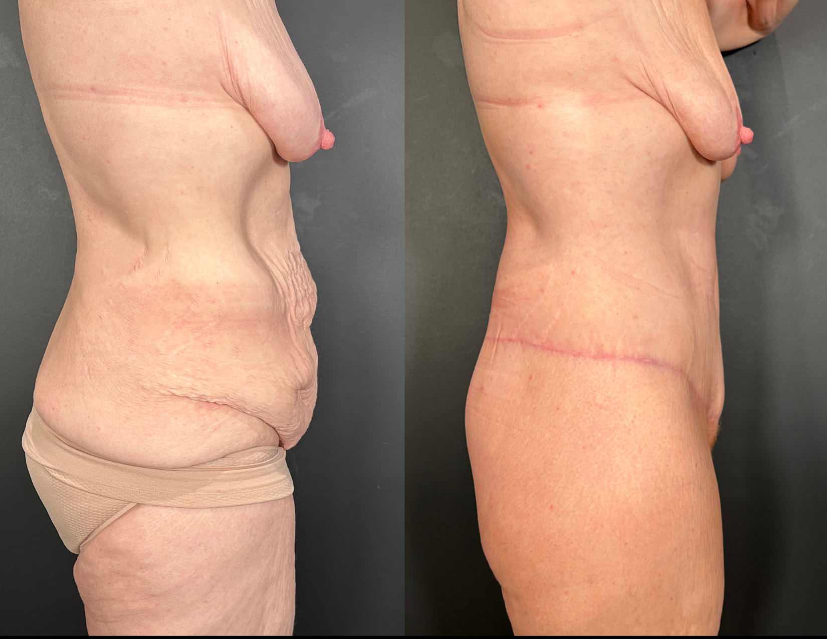 3 months post OP aBDOMINOPLASTY WITH LIPOSUCTION (40).png