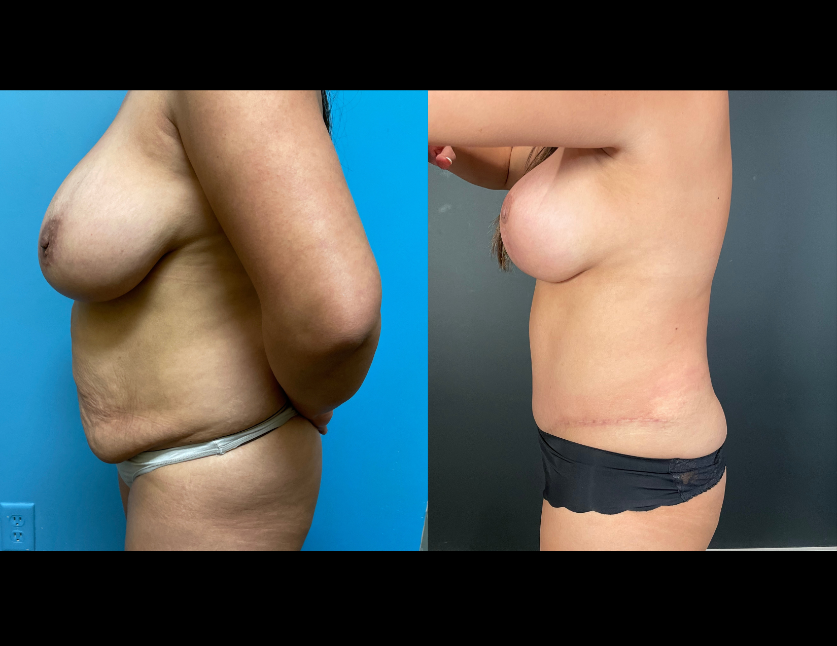 3 months post OP aBDOMINOPLASTY WITH LIPOSUCTION (26).png