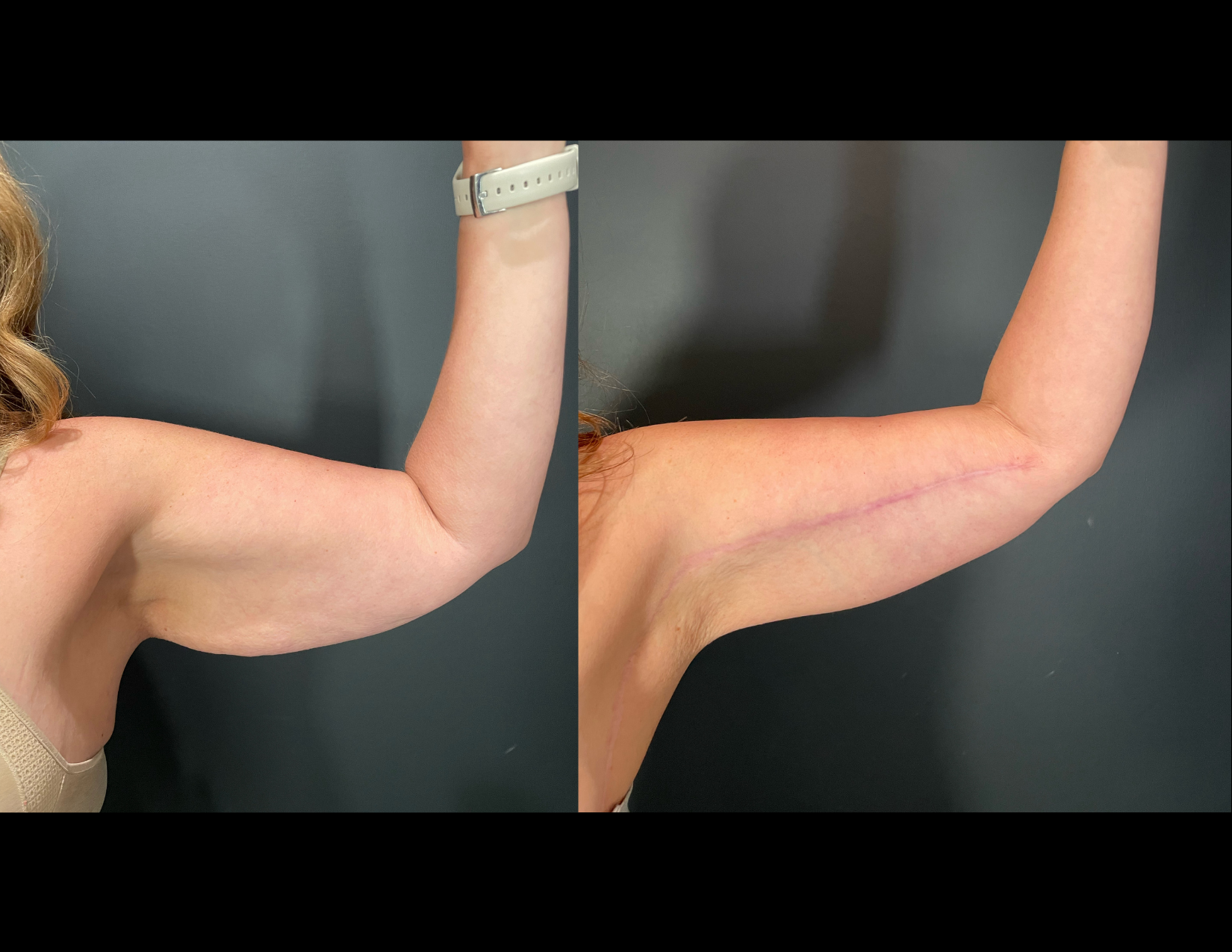 3 months post OP aBDOMINOPLASTY WITH LIPOSUCTION (18).png