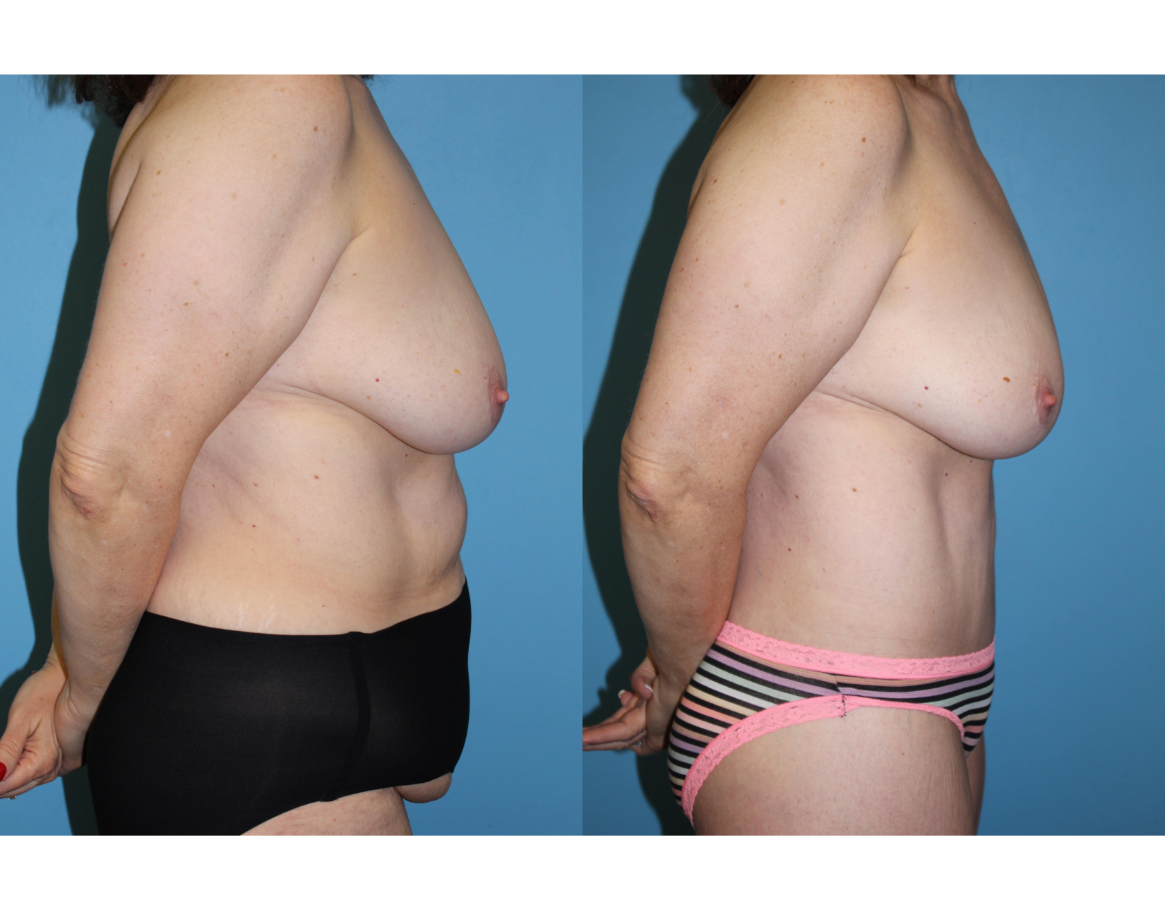3 months post OP aBDOMINOPLASTY WITH LIPOSUCTION (54).png