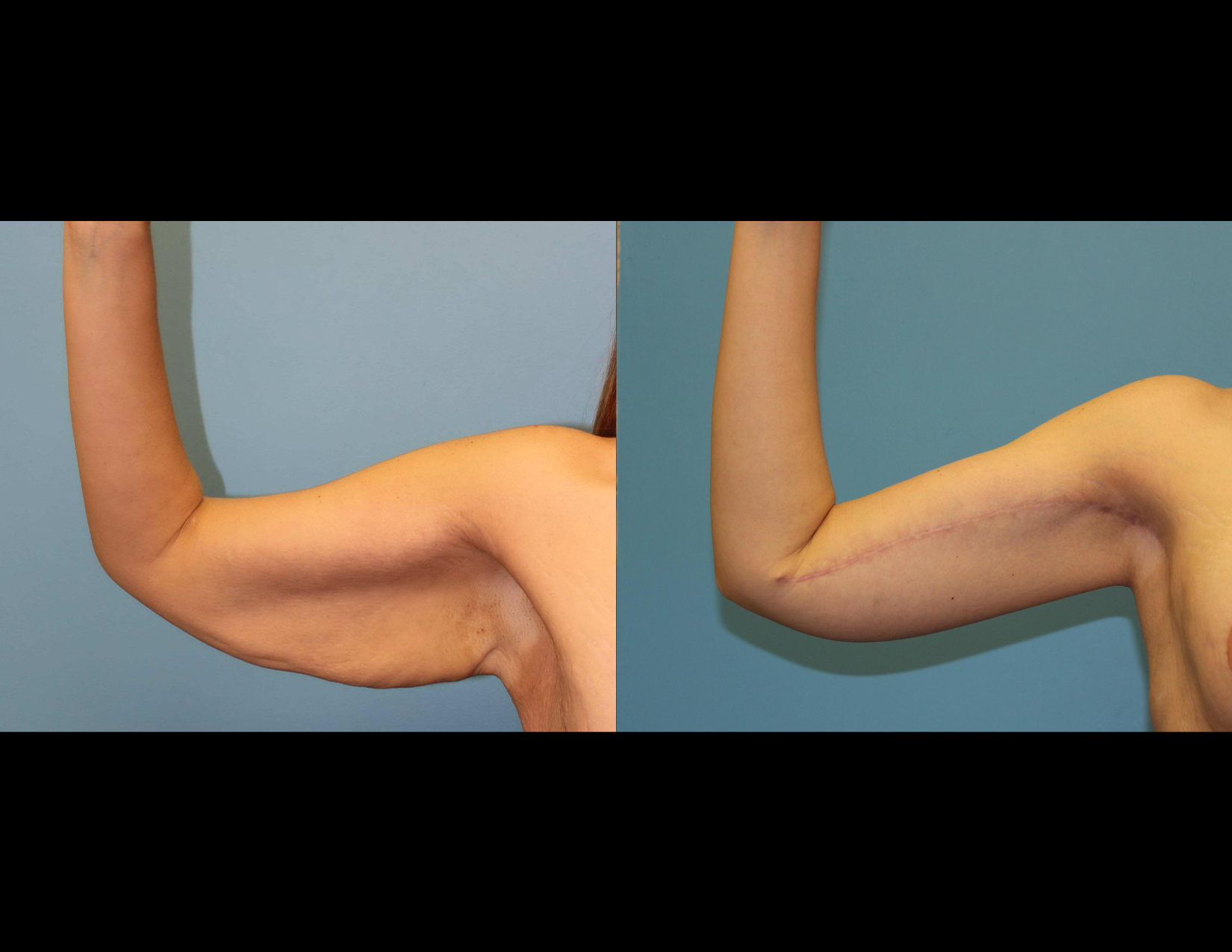 3 months post OP aBDOMINOPLASTY WITH LIPOSUCTION (23).png