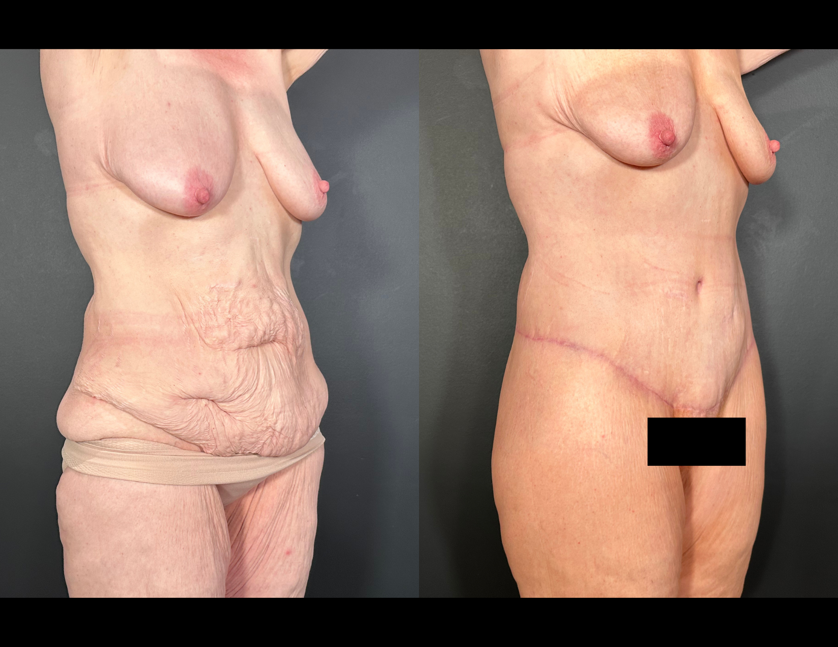 3 months post OP aBDOMINOPLASTY WITH LIPOSUCTION (39).png