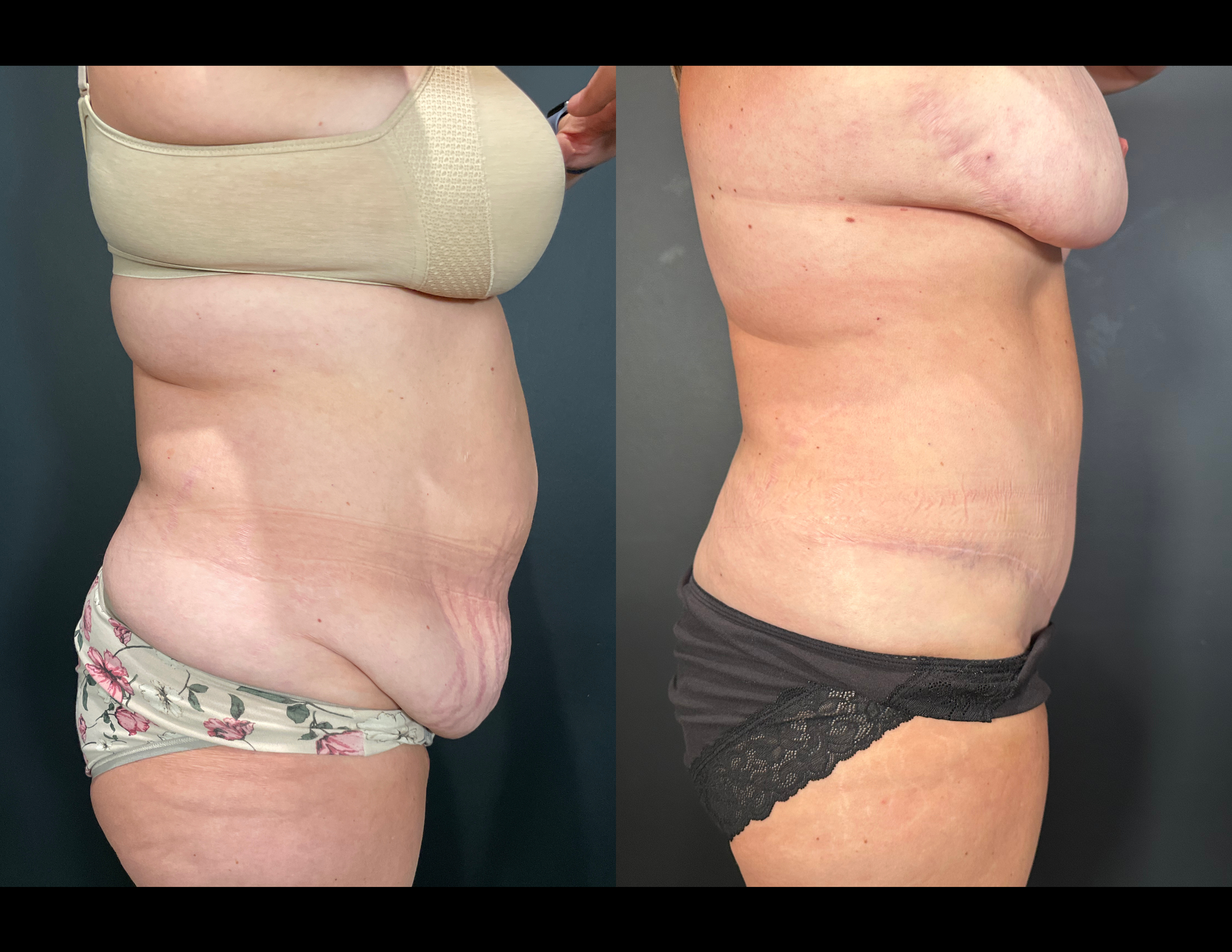 3 months post OP aBDOMINOPLASTY WITH LIPOSUCTION (47).png