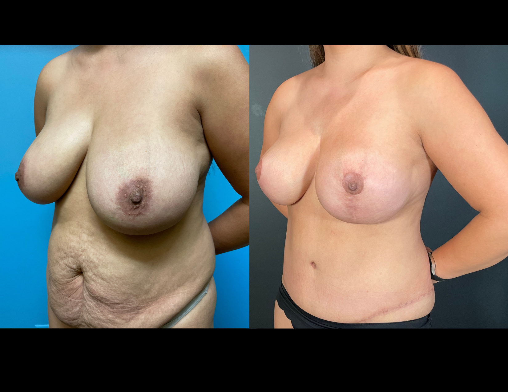 3 months post OP aBDOMINOPLASTY WITH LIPOSUCTION (25).png
