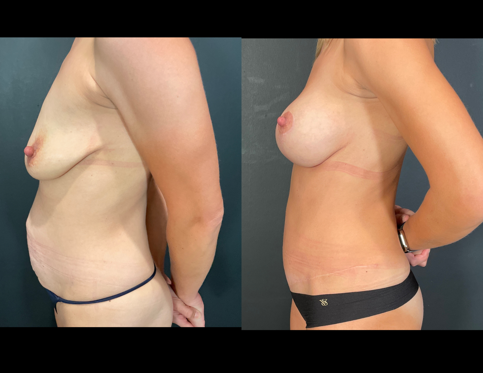 3 months post OP aBDOMINOPLASTY WITH LIPOSUCTION (33).png