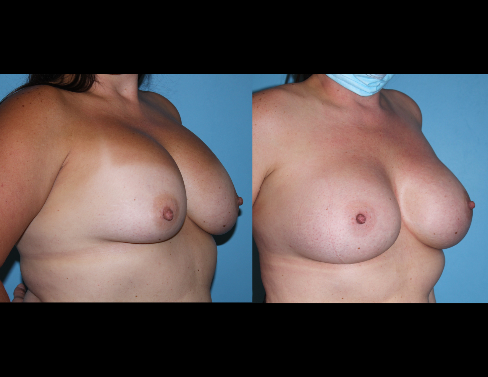 3 months post OP aBDOMINOPLASTY WITH LIPOSUCTION (36).png