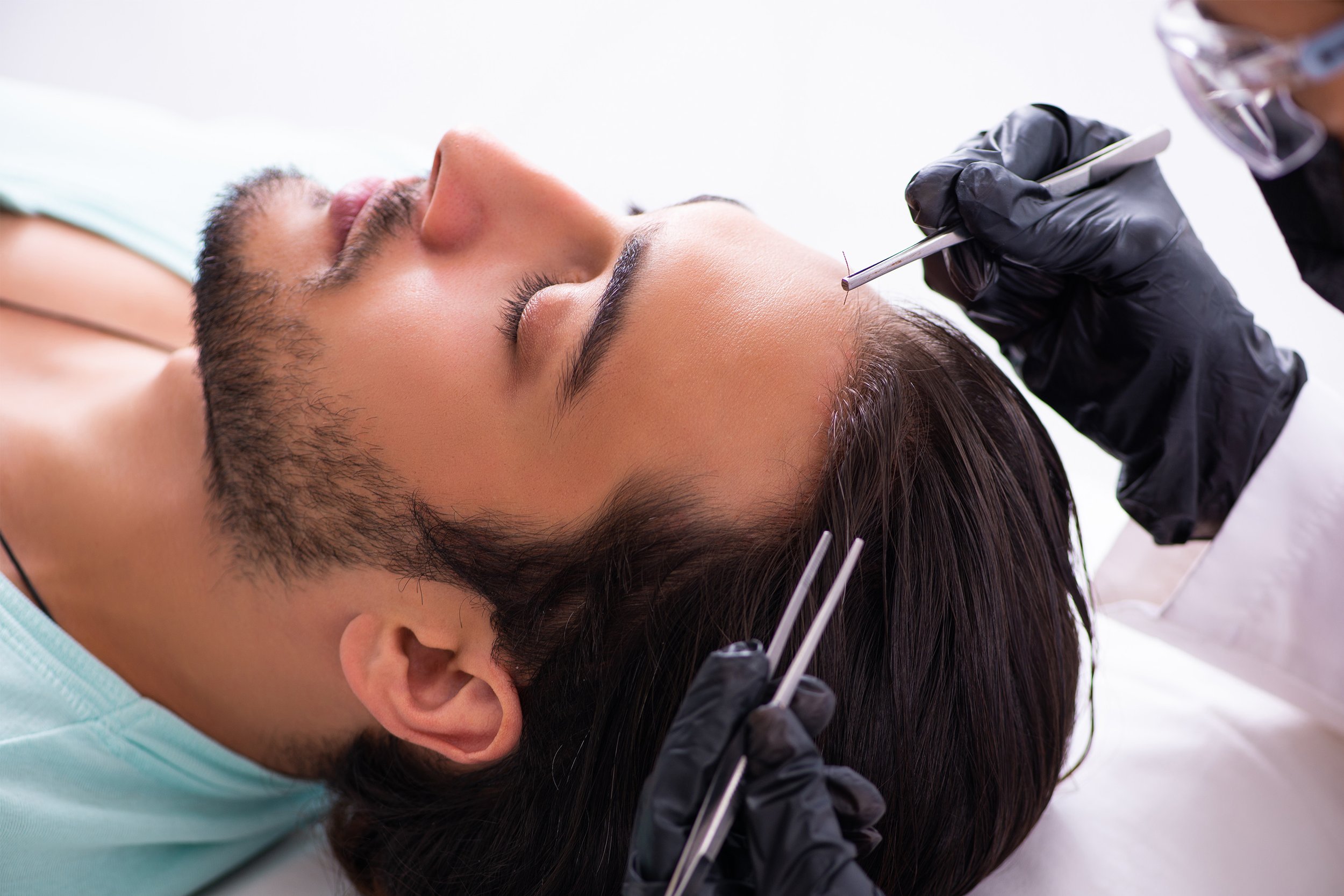 The Reality of Hair Transplants; Not a Quick Fix Solution